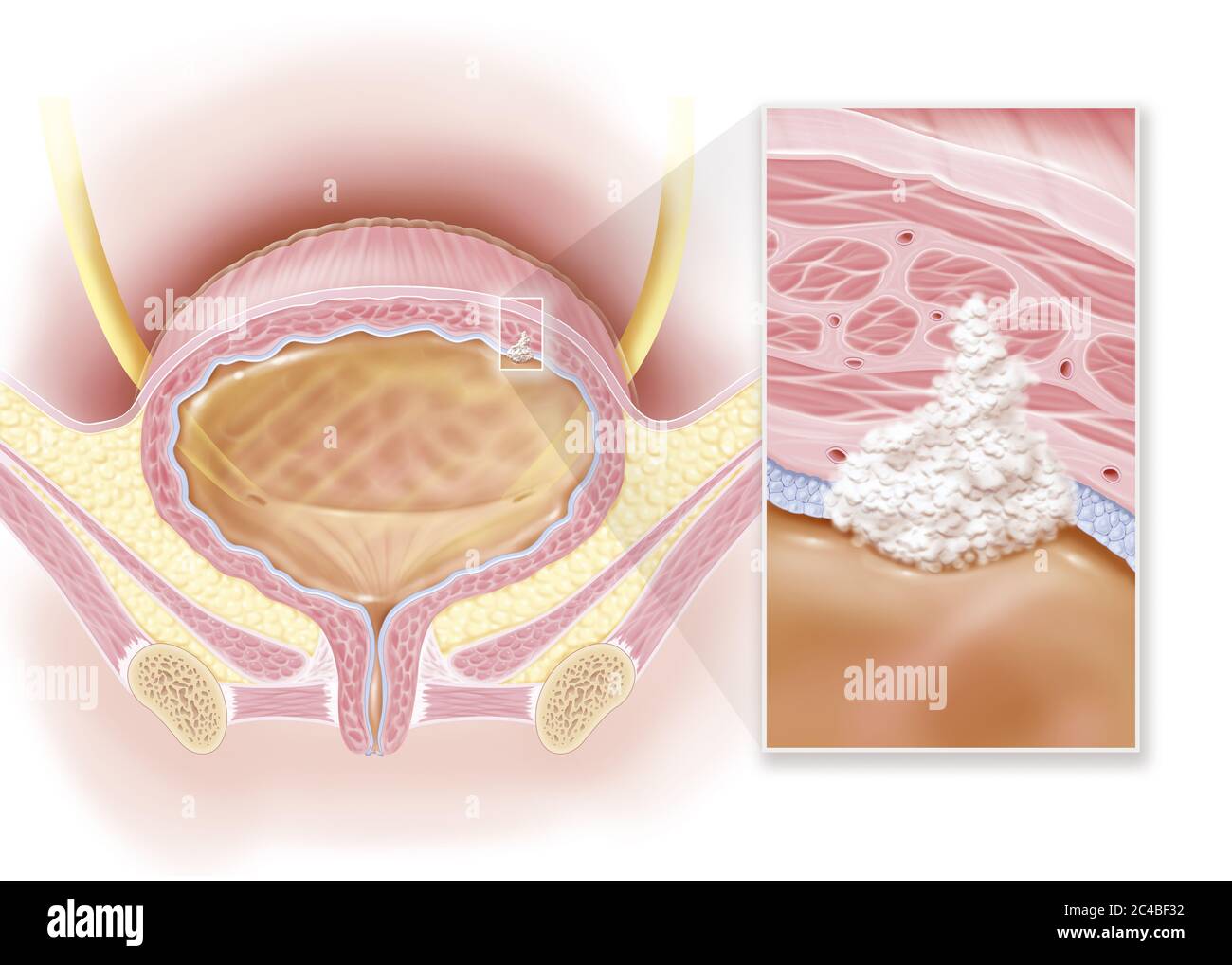 Invasive bladder cancer, stage II, muscle damage. This illustration shows a woman's bladder with a stage II invasive cancerous tumor at the top right Stock Photo