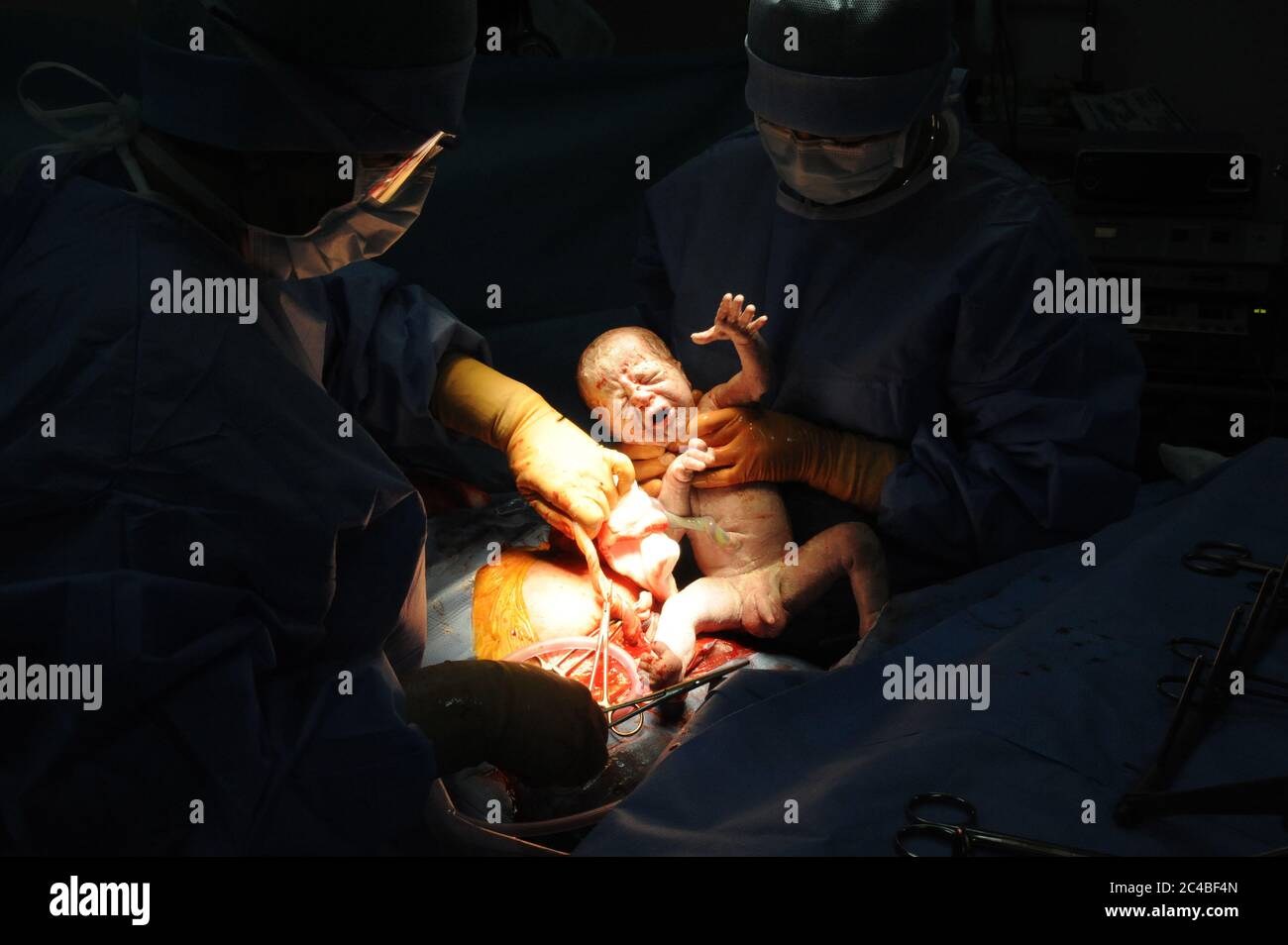 Report at the maternity hospital of the Abbeville hospital. Cesarean delivery of a woman pregnant with twins. Scheduled intervention. Presence in the Stock Photo
