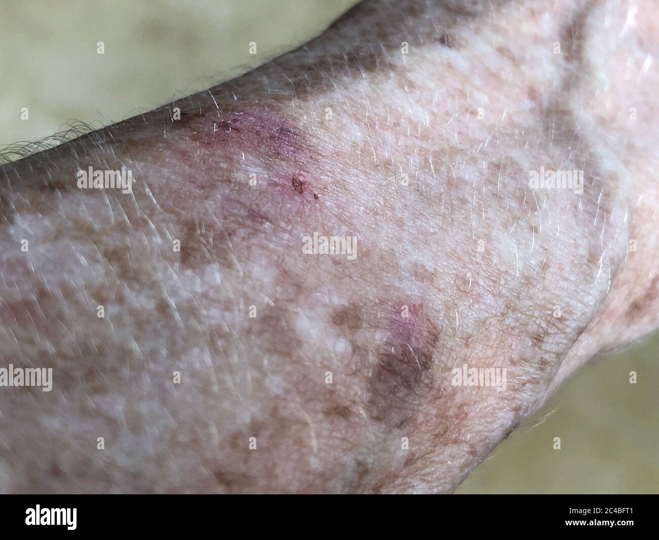 Age spots on the forearm of a 72-year-old woman. Stock Photo