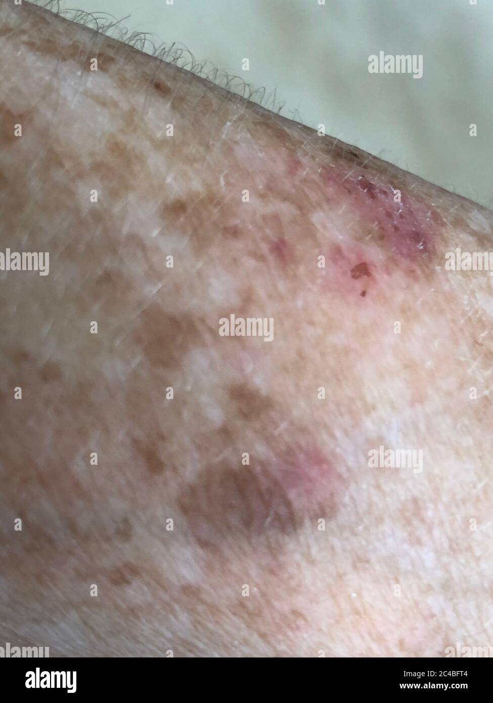 Age Spots On The Forearm Of A 72 Year Old Woman Stock Photo Alamy