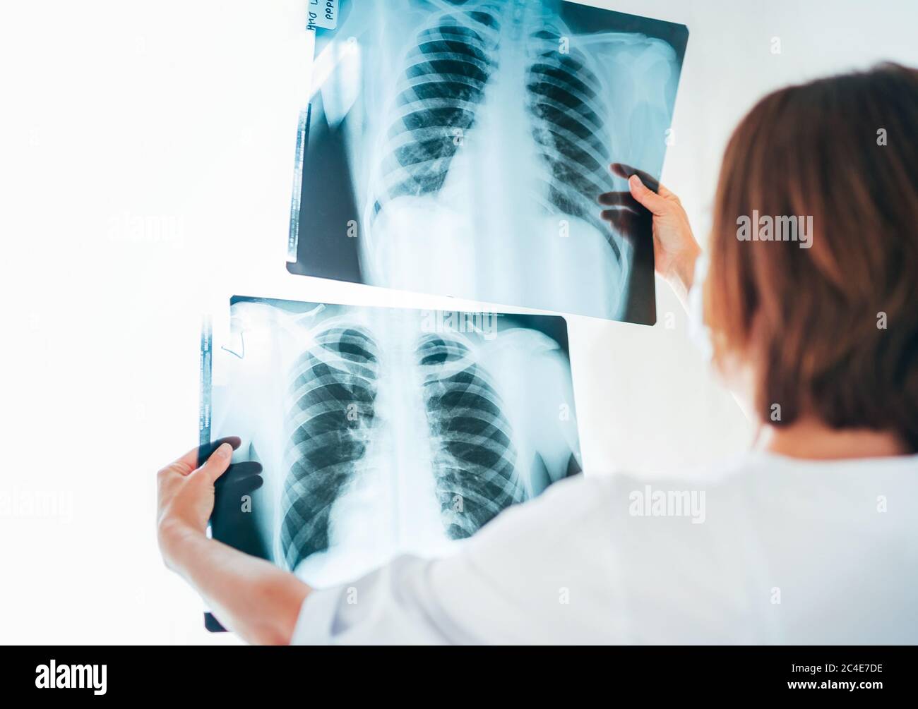 Female doctor comparing two patient's chest x-ray film lungs scans at radiology department in hospital.Lung disorders or Covid-19 scan lungs xray dete Stock Photo
