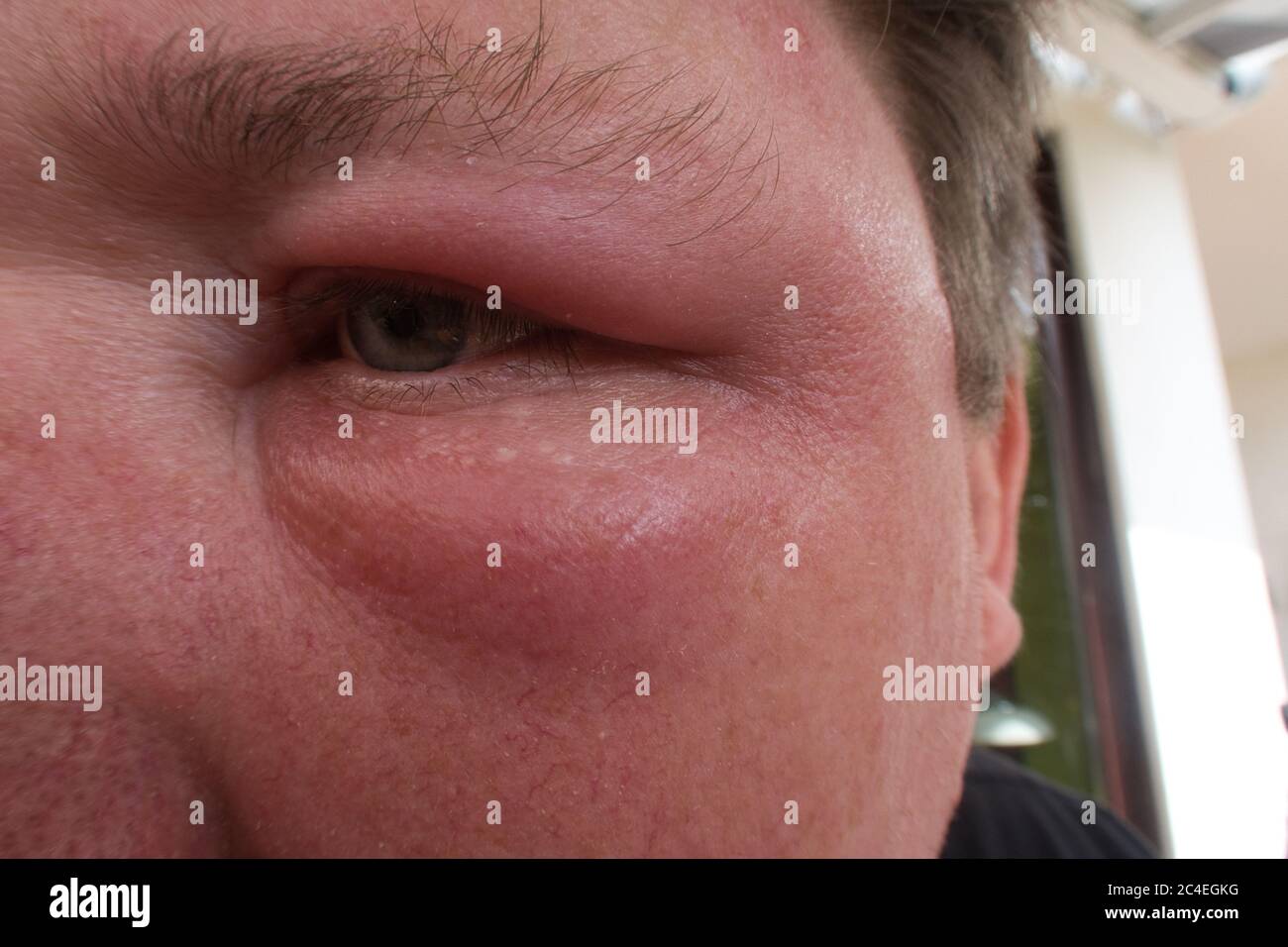 Closeup shot of a female swollen eye from a bee sting Stock Photo - Alamy