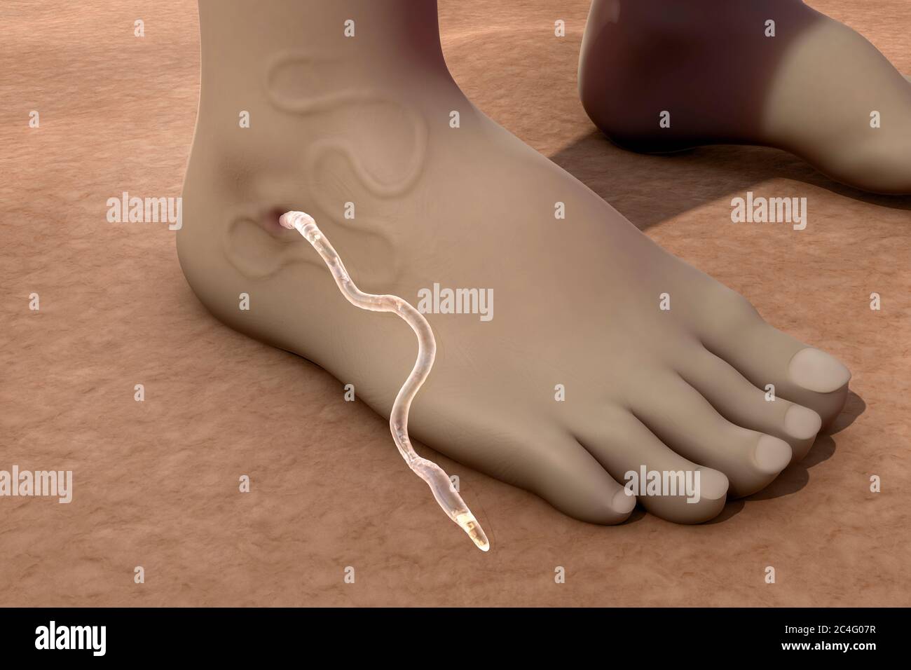 Illustration of a guinea worm (Dracunculus medinensis) emerging from an infected foot. The white thread-like worm is seen at centre; the female worm i Stock Photo