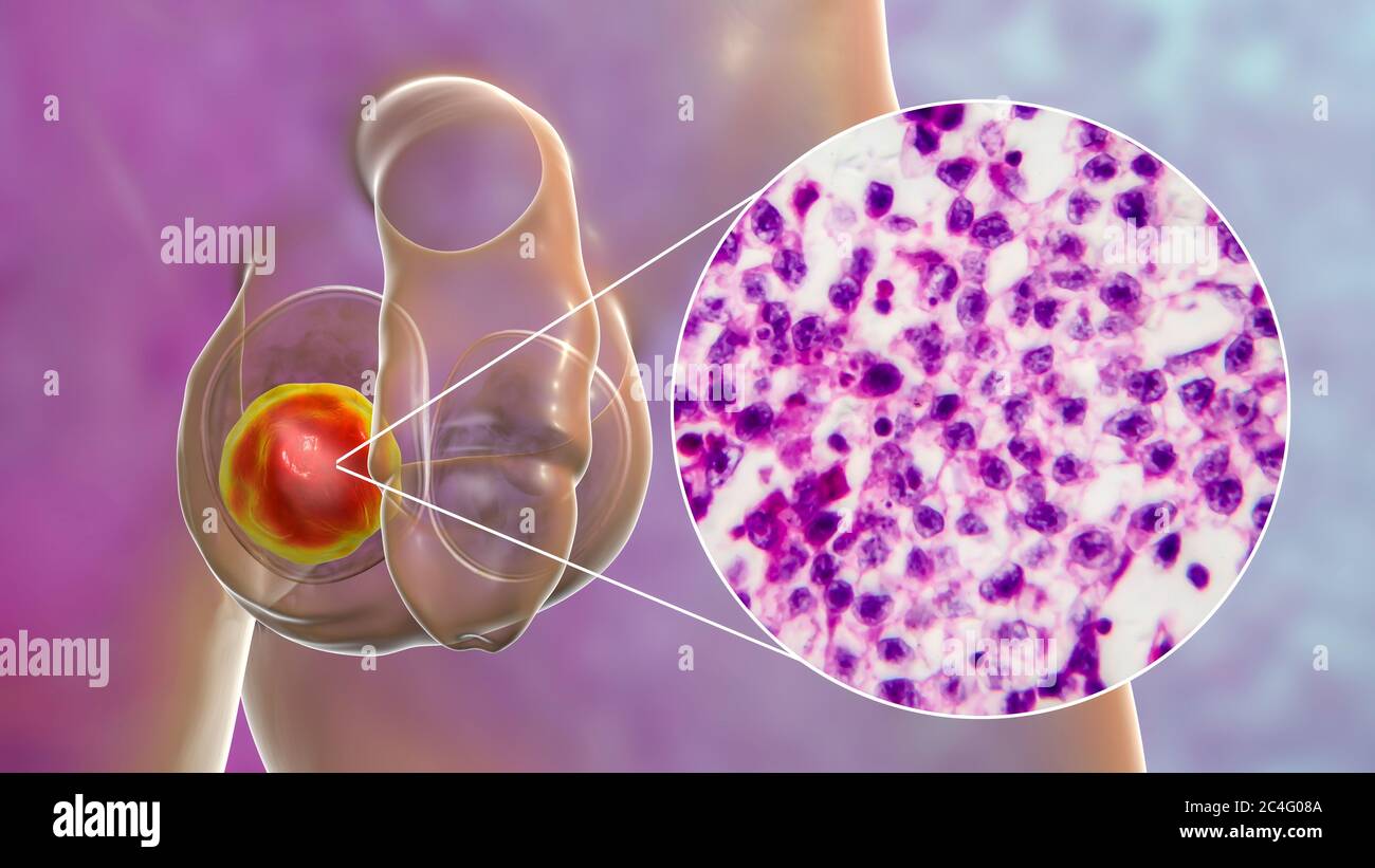 Testicular cancer, a malignant spermatocytic seminoma, computer illustration and light micrograph. A seminoma is a malignant tumour (cancer) of the testis (testicle). Although this is a rare cancer, it is the most common cancer in 15 to 35 year old men. It arises from abnormal germ cells (precursors to sperm cells) in the seminiferous tubules. Surgical removal of the affected testis (orchidectomy) is followed by radiotherapy and chemotherapy if required. Stock Photo