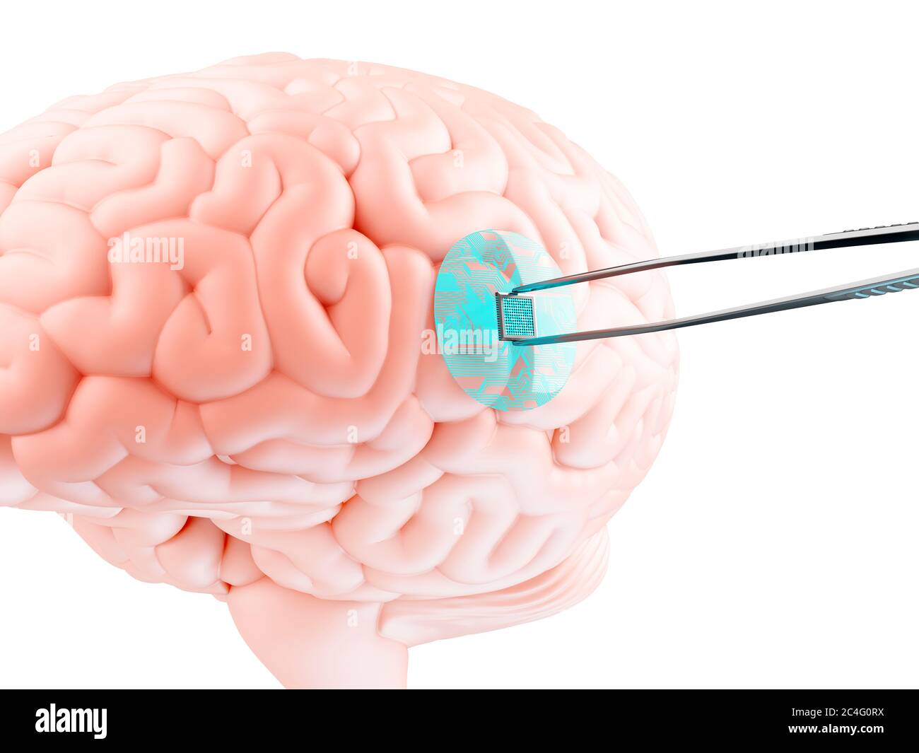 Implanting chip in human brain hires stock photography and images Alamy
