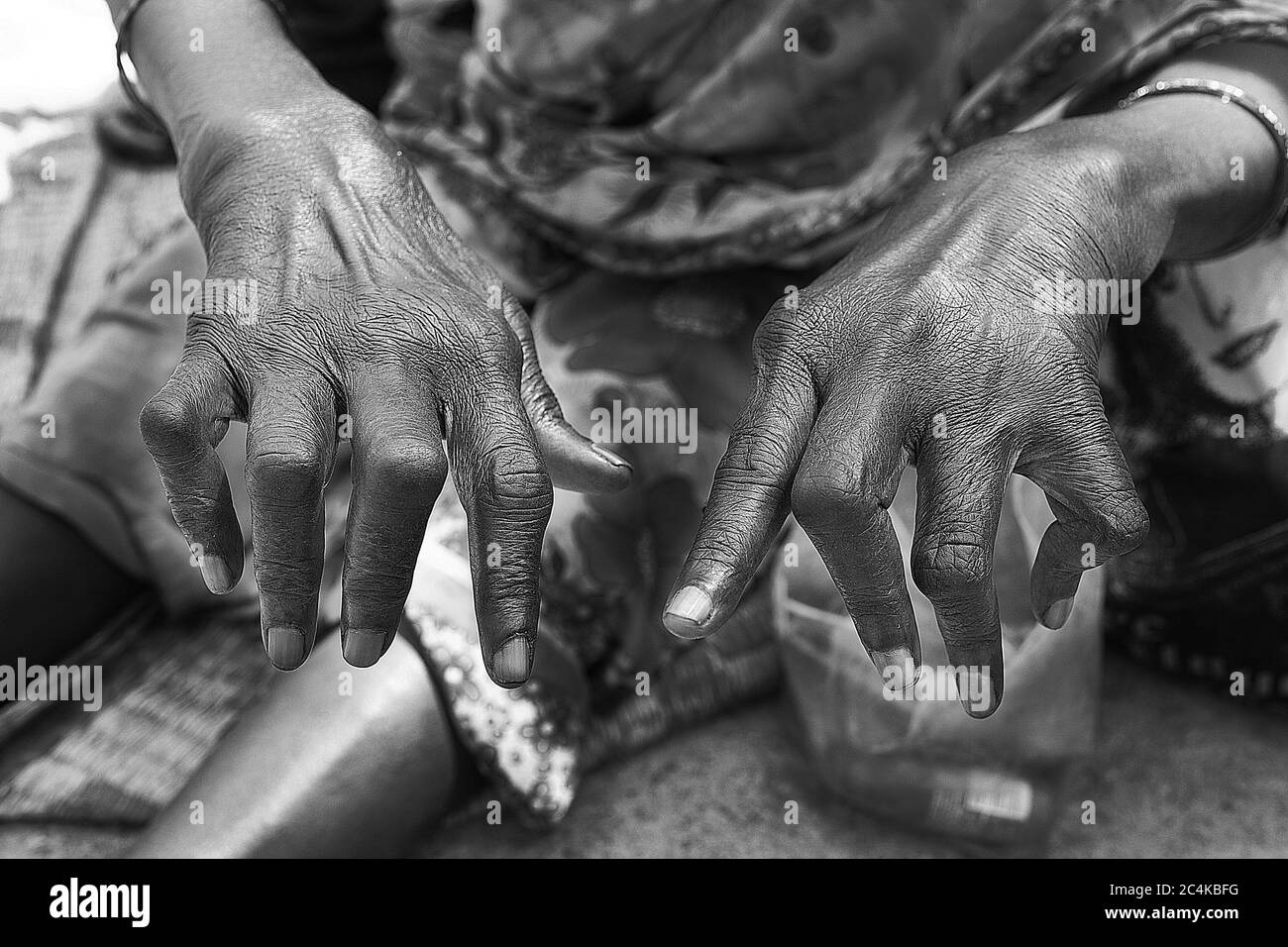 Suguna’s fingers are crippled with arthritis and she has self-confessed mental illness so she cannot seek work. She says she feels trapped and veers f Stock Photo