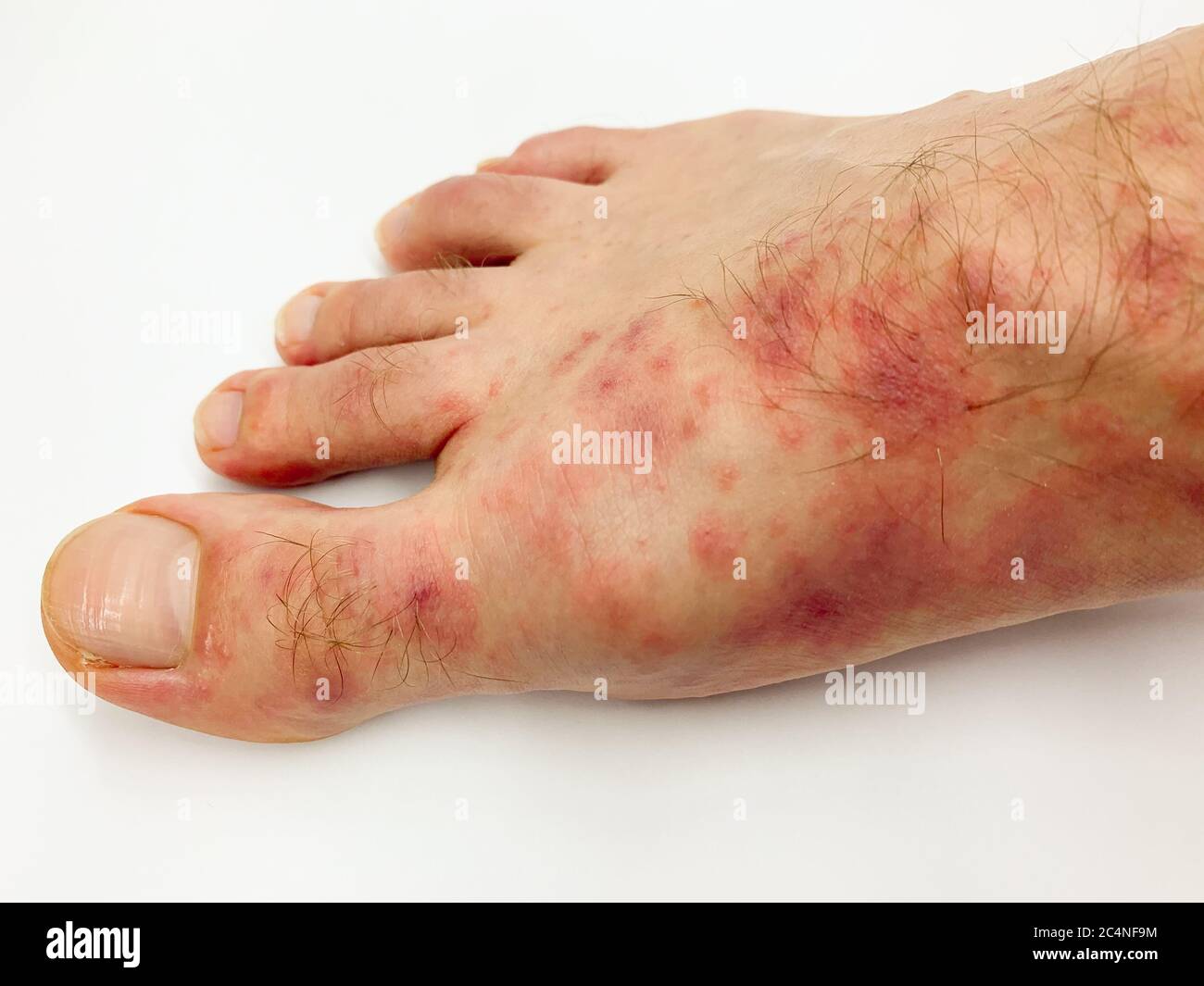 Close Up Of Male s Foot And Toes With Red Rash Desease On A White Close Up Of Male s Foot And Toes With Red Rash Desease On A White