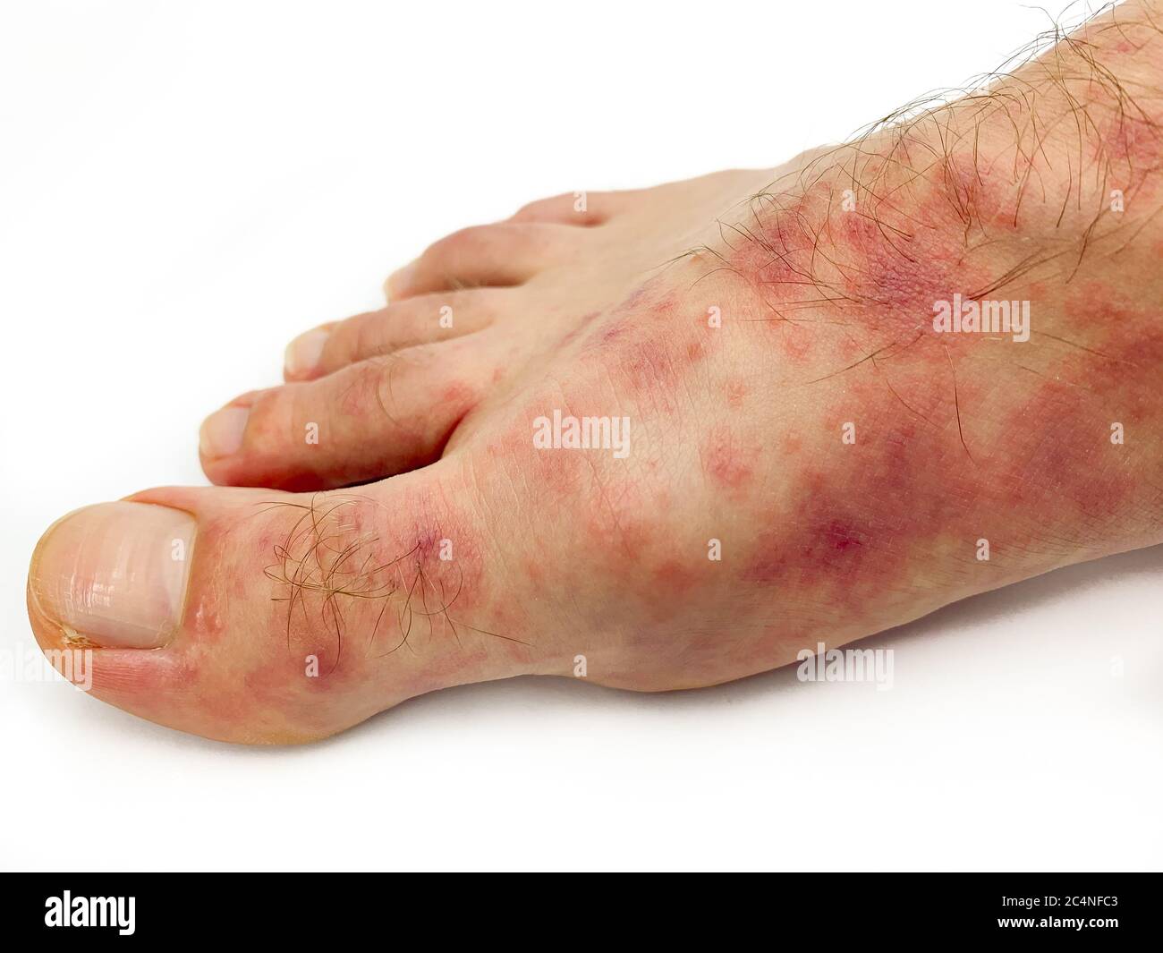 Salmonella Typhi Rose Spots