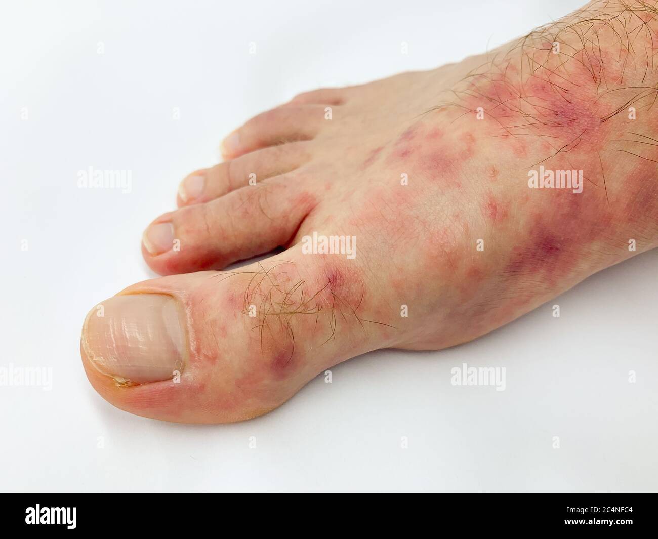Salmonella Symptoms Rash