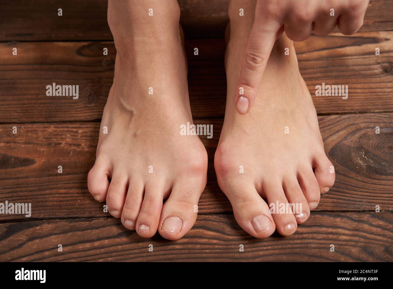 Hllux Valgus on female legs close up on wooden background. Foot joint deformity. Health care and medicine problem with human body Stock Photo