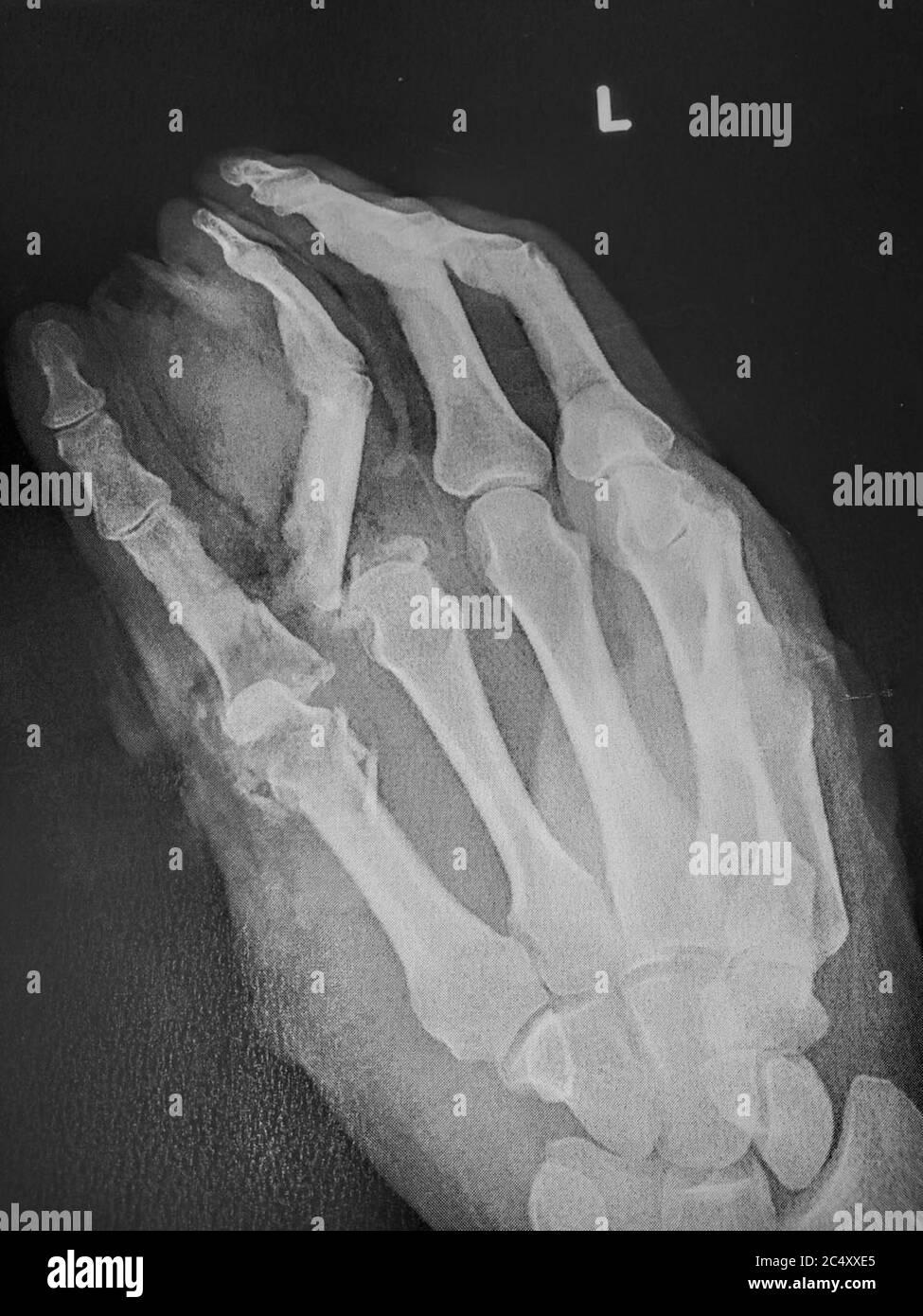 Xray of broken fingers before and after operation Stock Photo Alamy