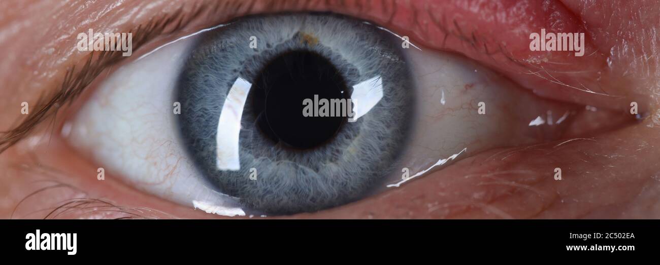 Sty on human eye closeup skin disease Stock Photo