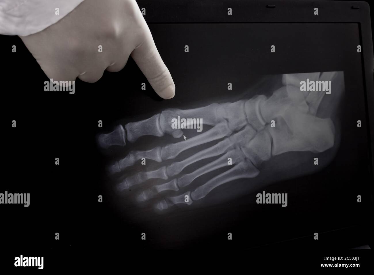 X-ray of the foot. The doctor points a finger at the growths on the bone. Stock Photo