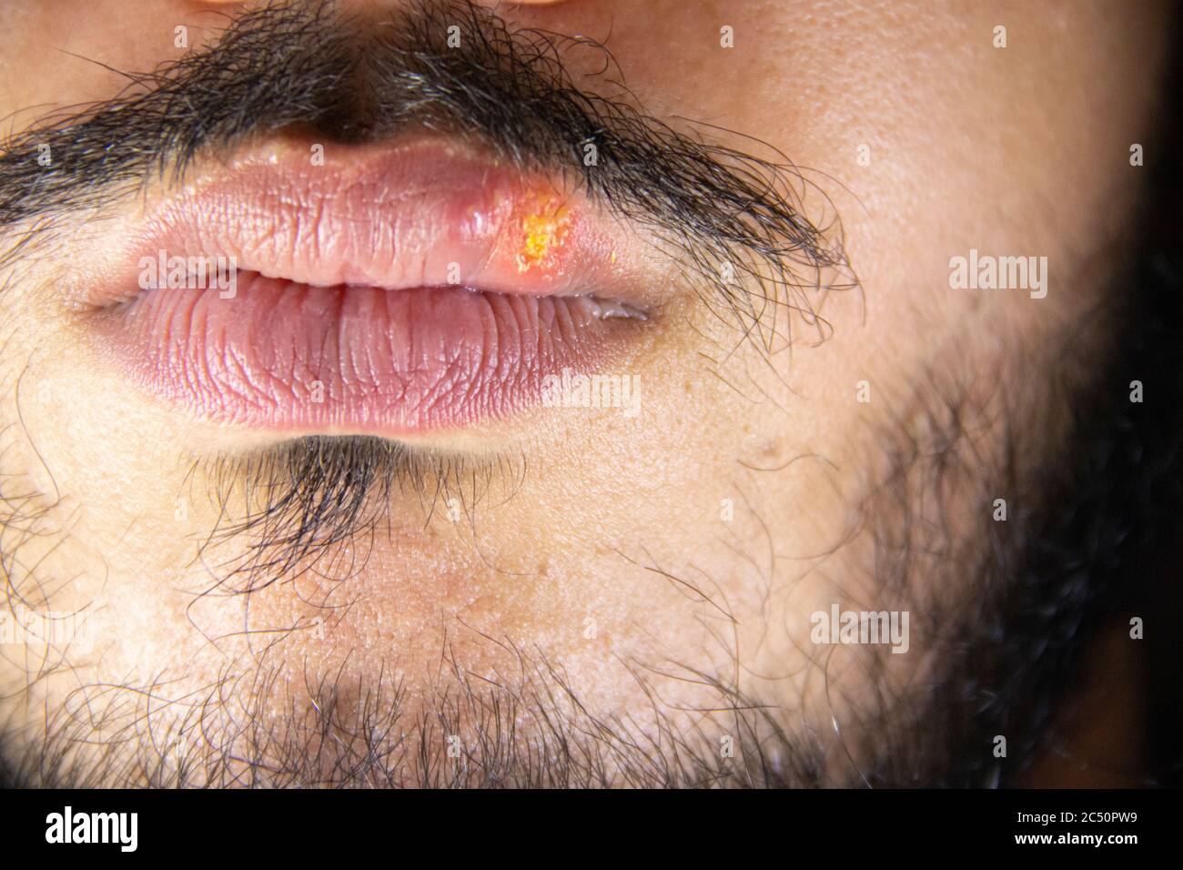 Close up detail caucasian bearded male who has suffering herpes simplex virus on lips. Stock Photo
