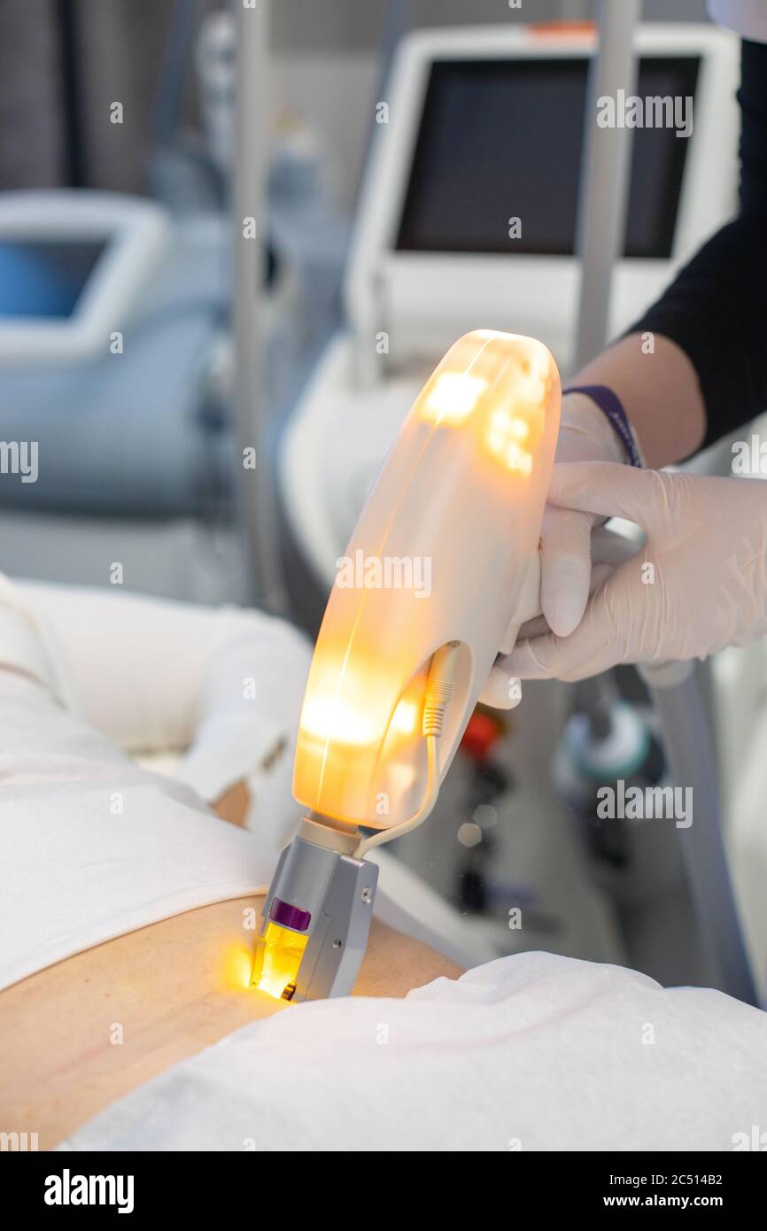 Resurfacing treatment made on womans stomach by professional therapist. Scar removing procedure with specialized equipment in cosmetology salon. Stock Photo