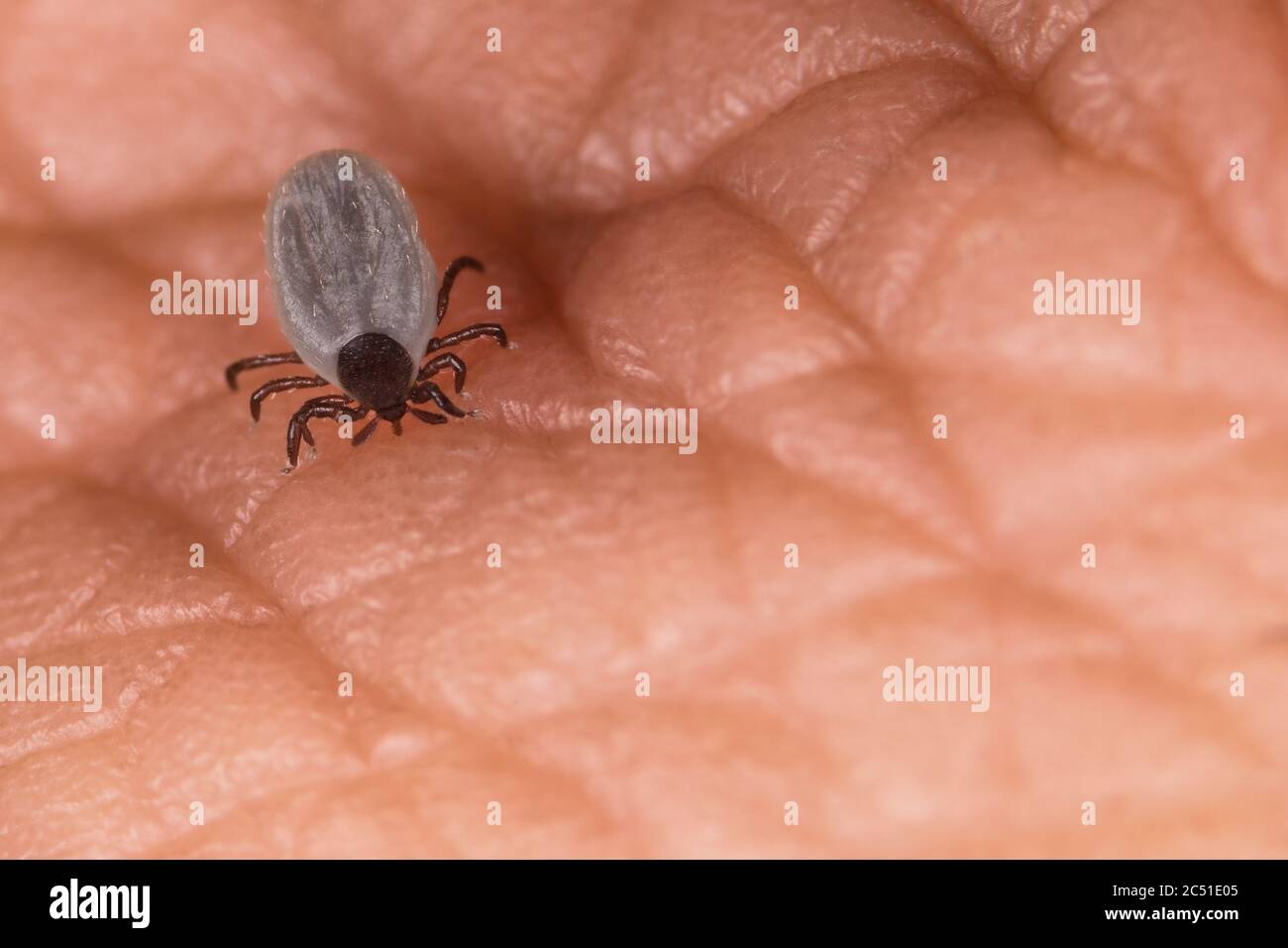 Biting castor bean tick with hypostom penetrating a skin and outstretched palps. Ixodes ricinus. Small female parasitic mite piercing human epidermis. Stock Photo
