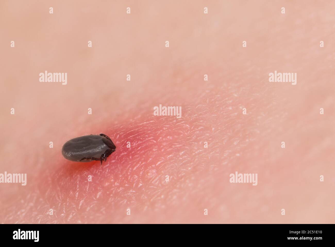 Female castor bean tick sucking blood in red irritated skin. Ixodes ricinus. Fattened parasite full of blood bitten in human epidermis. Lyme disease. Stock Photo
