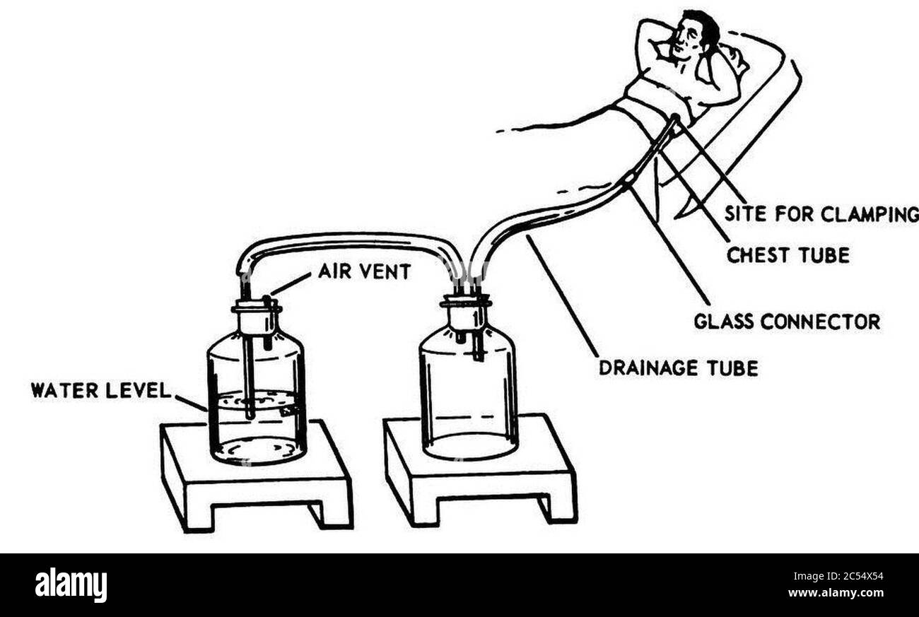 Intercostal catheter hires stock photography and images Alamy