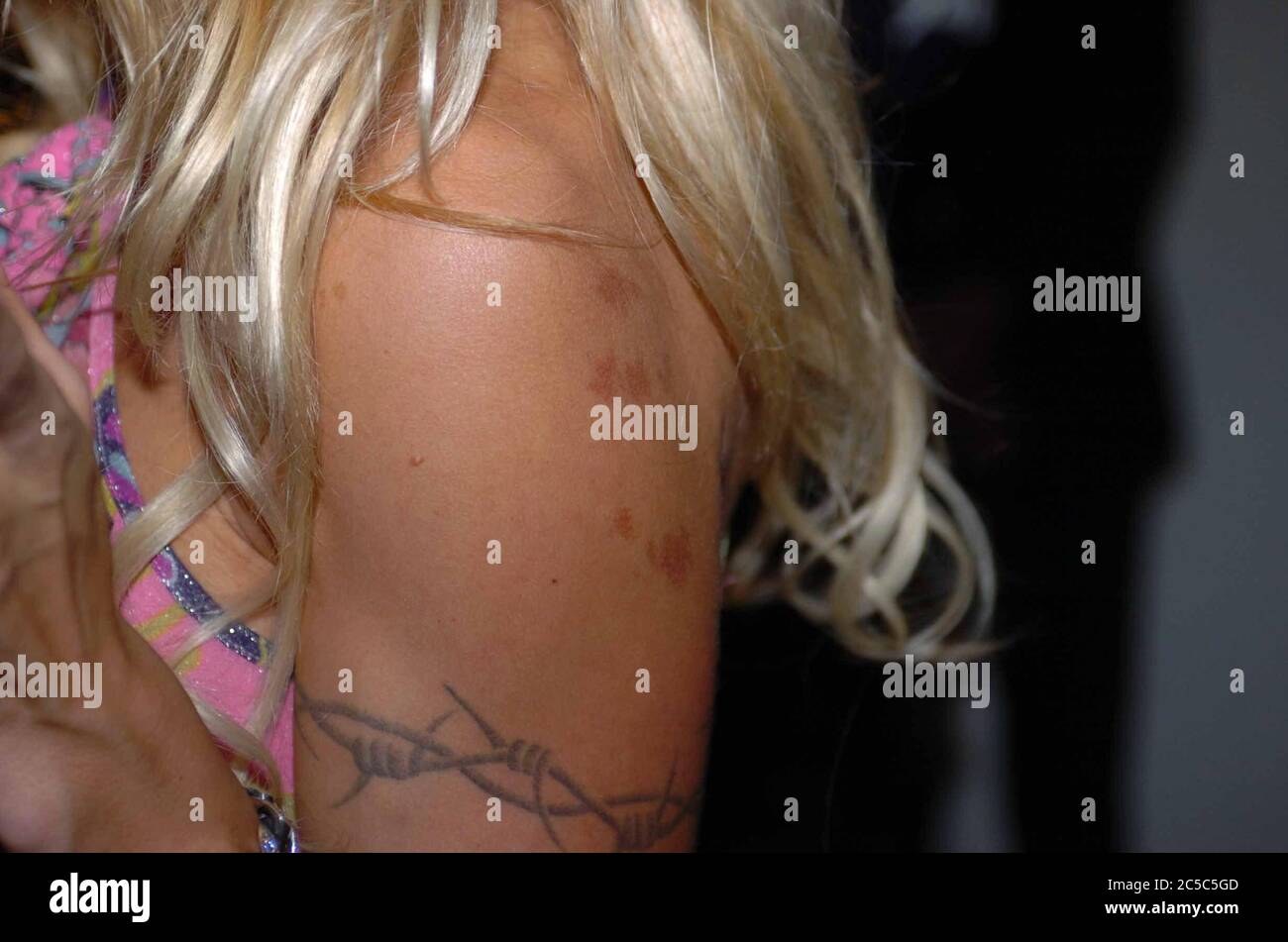 MIAMI BEACH, FL - FEBRUARY 19:  Pamela Anderson shows signs of brusing or cupping in South Beach on February 19, 2004 in Miami, Florida   People:  Pamela Anderson Stock Photo
