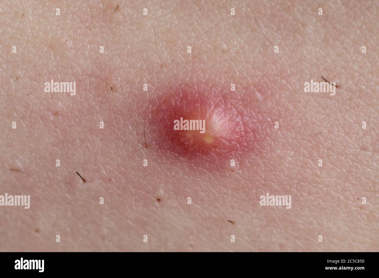 pimple on skin infection Pimple to Popping Stock Photo - Alamy