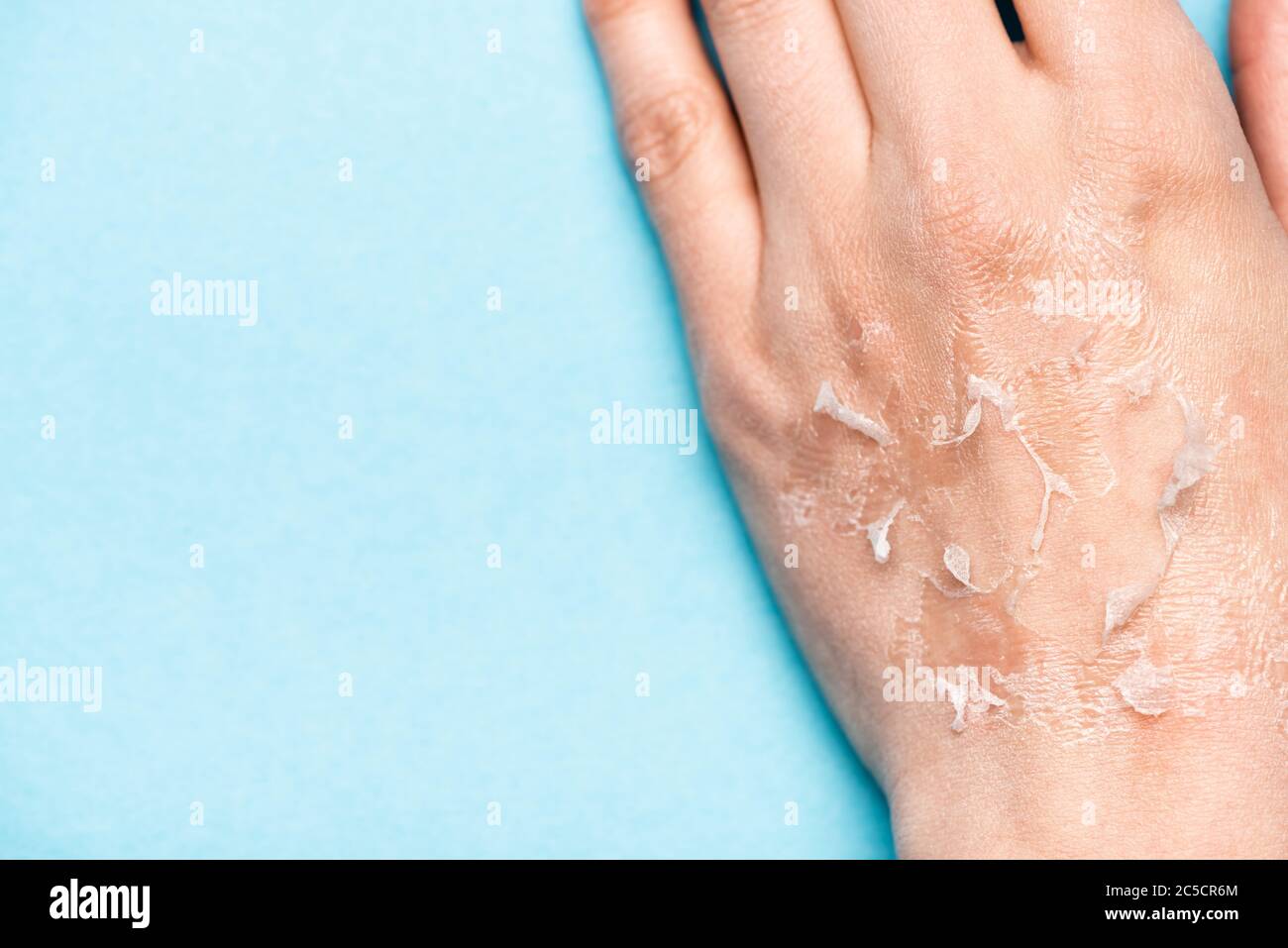 Dehydrated skin hires stock photography and images Alamy