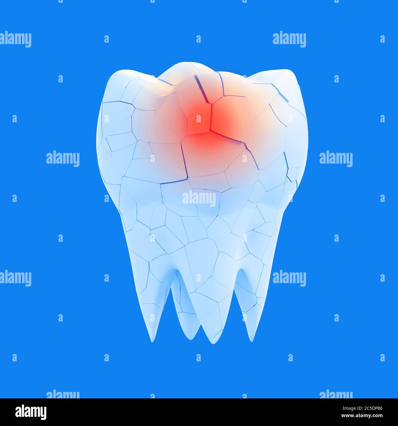 Broken molar tooth with red dot on blue background. Cracked Enamel Concept. The concept of sick