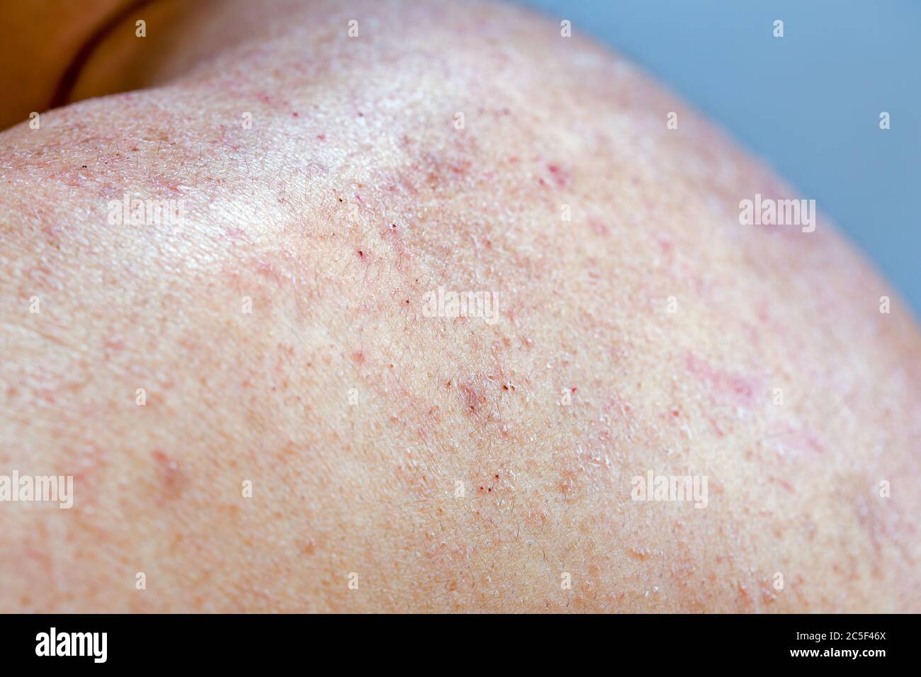 Extreme close-up photography of the atocpic dermatitis symptoms on the left shoulder of an adult male. Stock Photo
