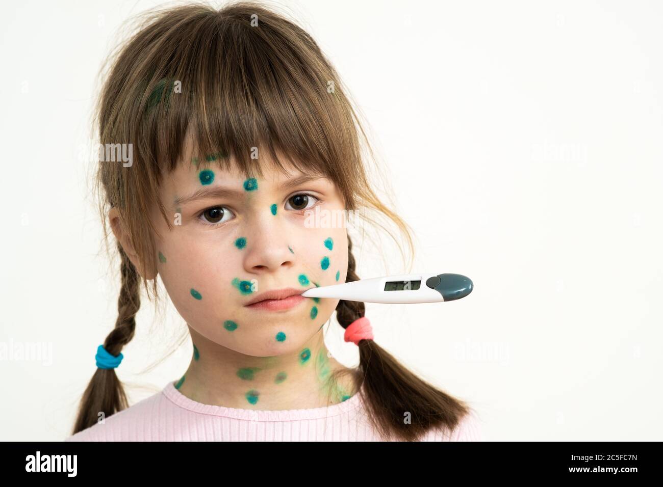 Child girl covered with green rashes on face ill with chickenpox, measles or rubella virus holding medical thermometer in her mouth having high temper Stock Photo