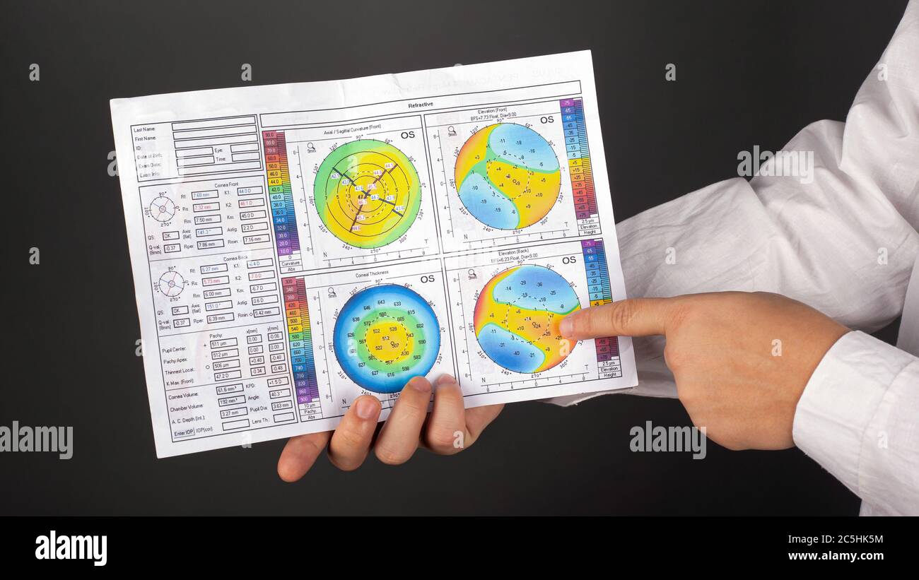 Kiev, Ukraine - 07.07.2019 keratoconus 2-3 degrees. corneal dystrophy. corneal topography. Stock Photo