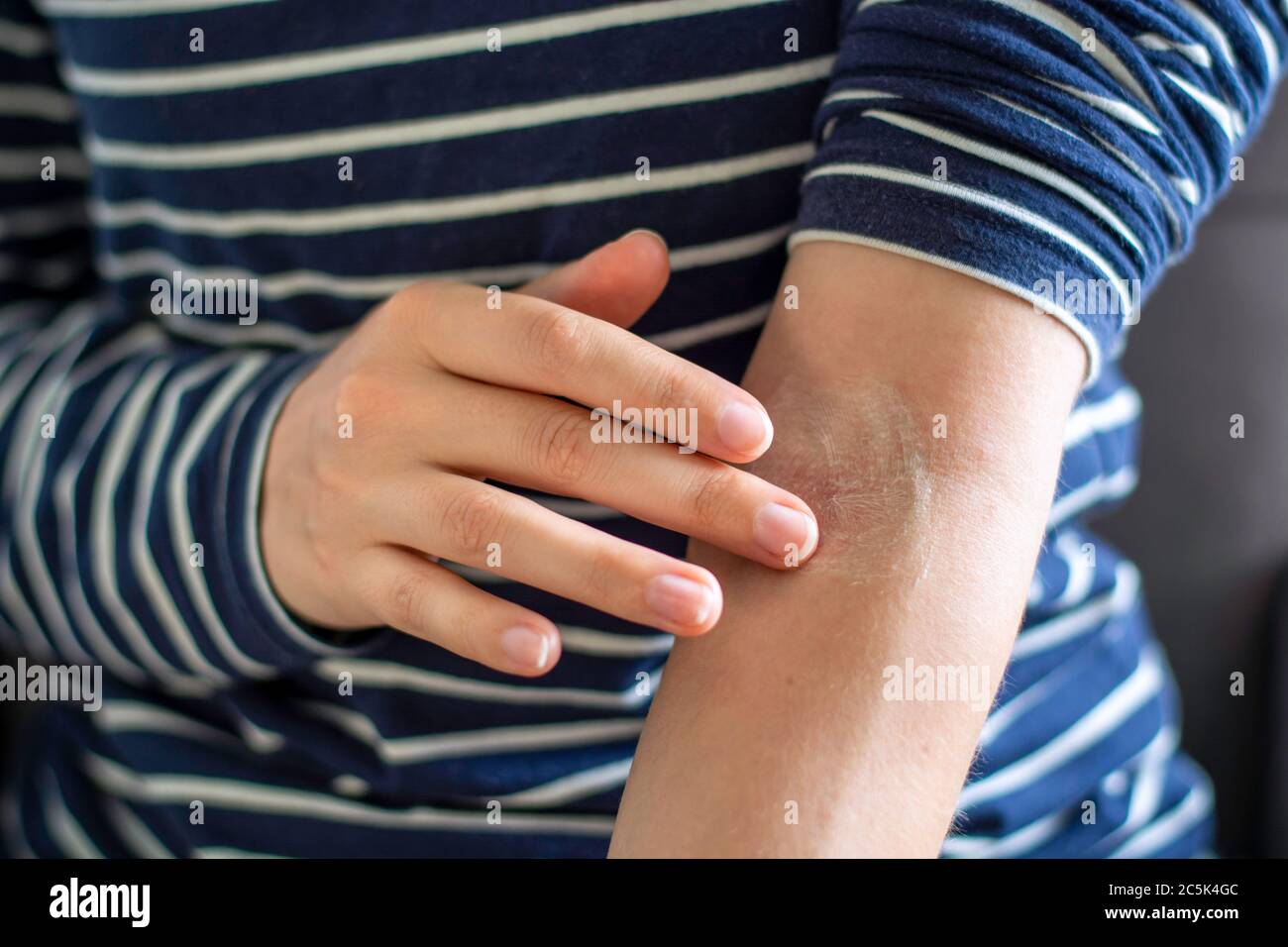 Skin rash on elbow hires stock photography and images Alamy