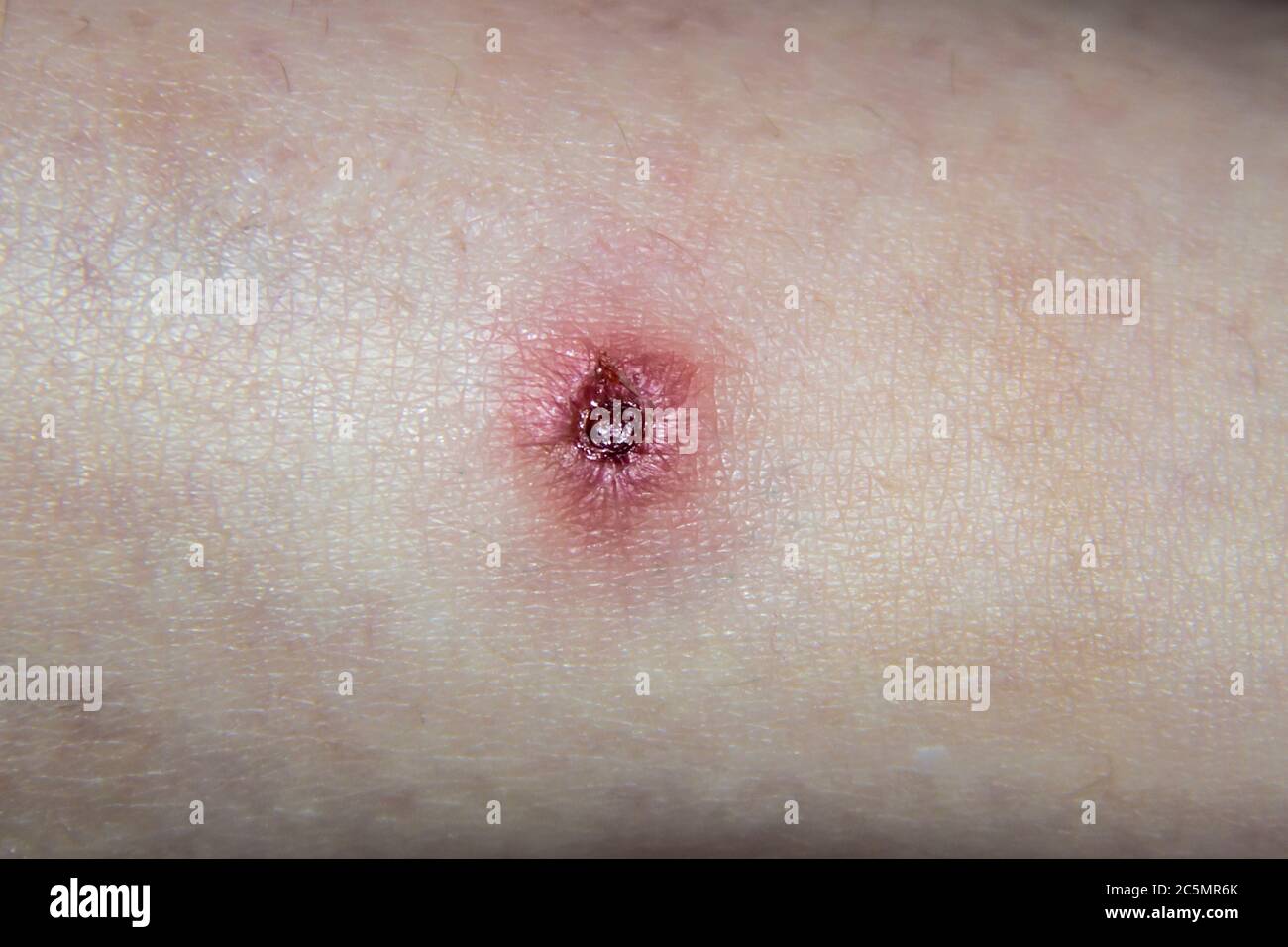 Torn wound from inflammation, acne on the human skin. Red infected wound on  the normal skin of human leg. Torn off a bleeding pimple on the skin Stock  Photo - Alamy