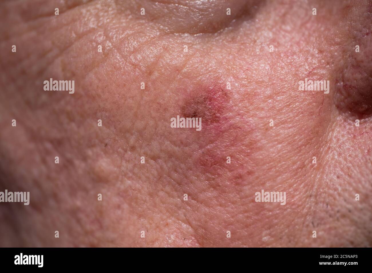 Red crusty lesions of actinic keratosis or sunspots on sun-damaged skin on the cheek under the right eye of a man Stock Photo