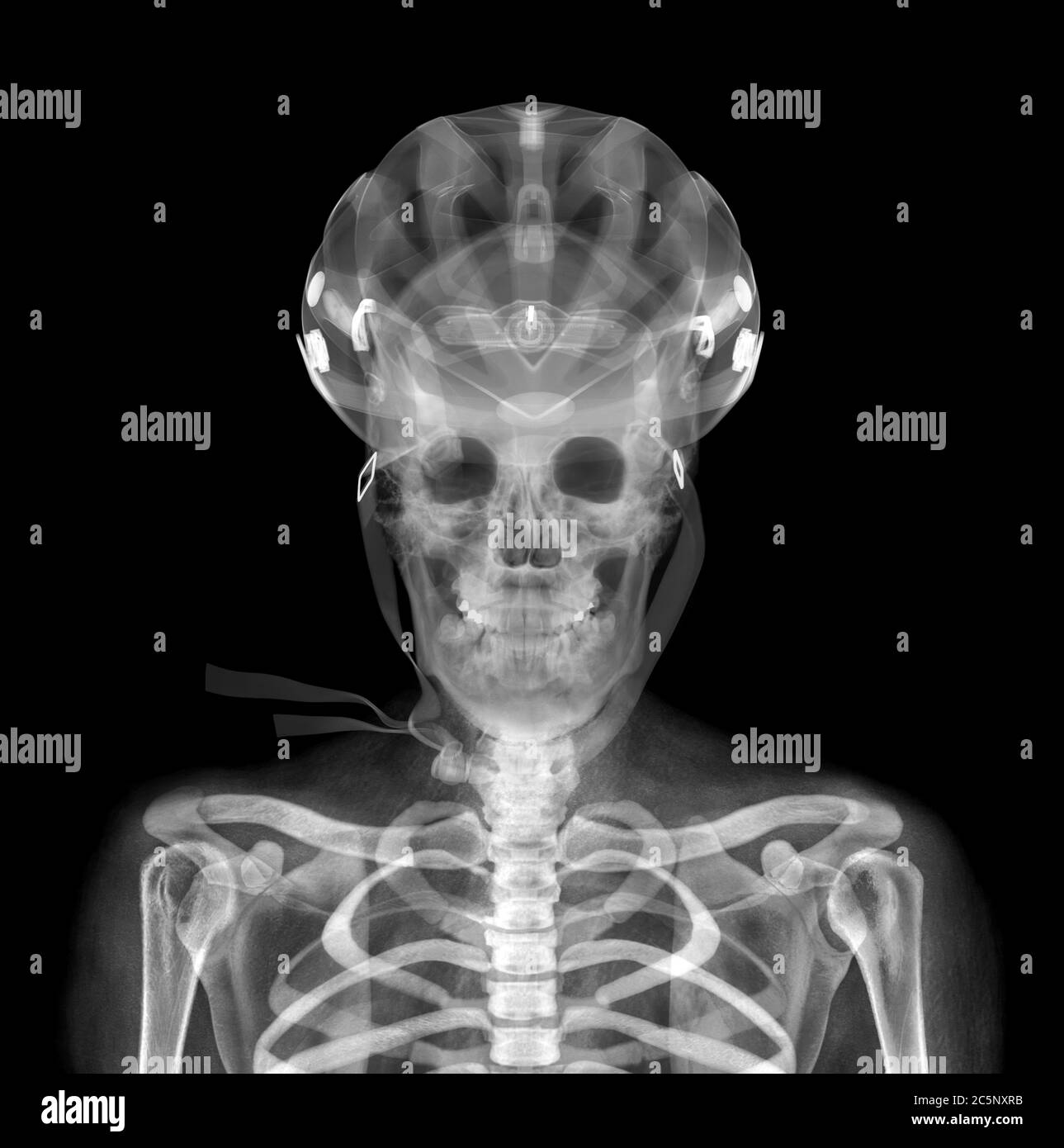 Skull and helmet, X-ray. Stock Photo