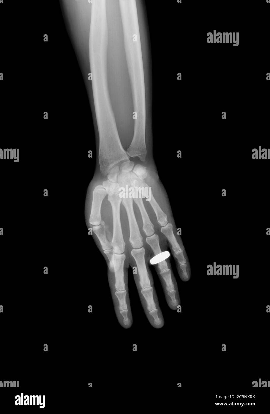 Hand x ray ring hires stock photography and images Alamy
