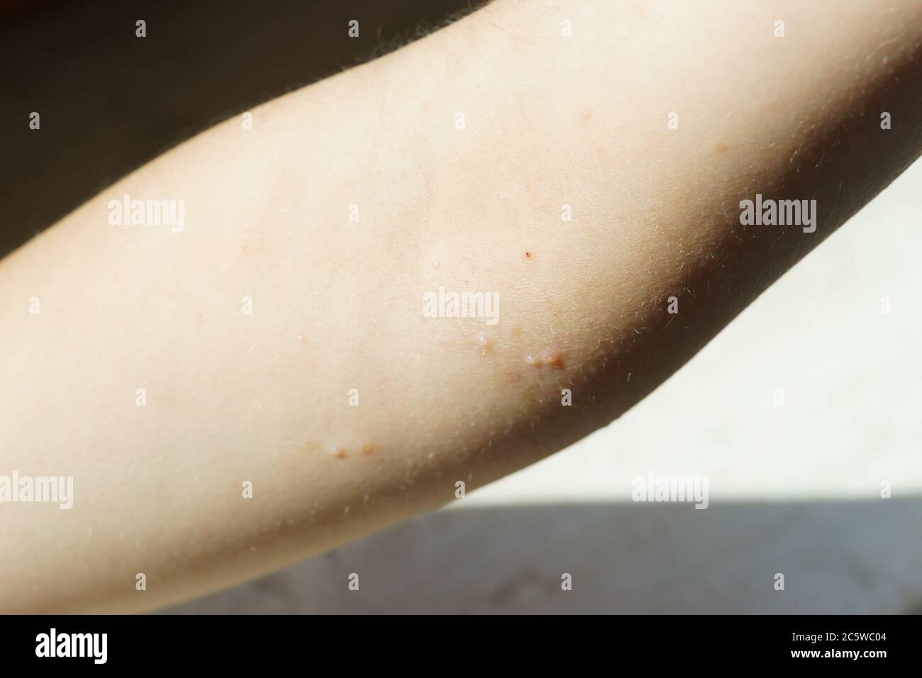 poxvirus - molluscum contagiosum virus (MCV) on children arm Stock ...