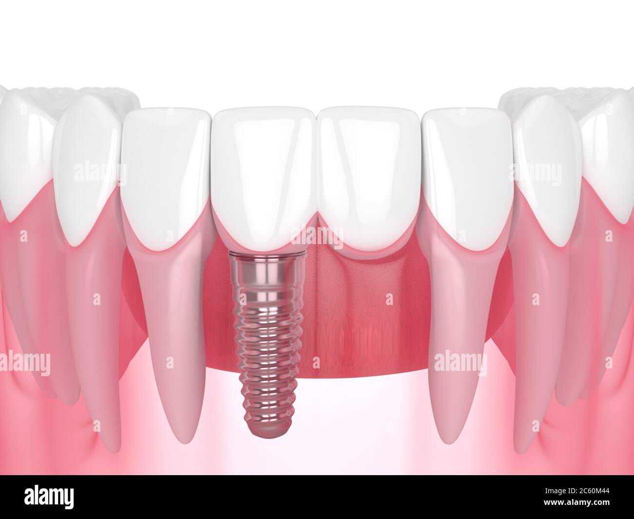 3d render of jaw with dental incisor cantilever bridge supported by