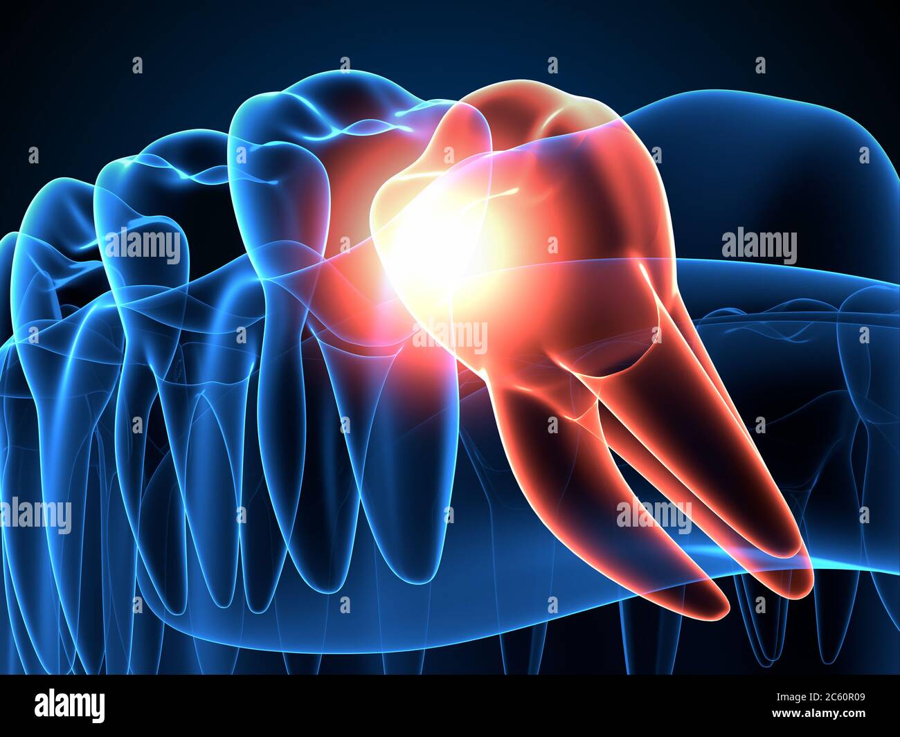 3d render of jaw x-ray with wisdom mesial impaction . Concept of different types of wisdom teeth problems. Stock Photo