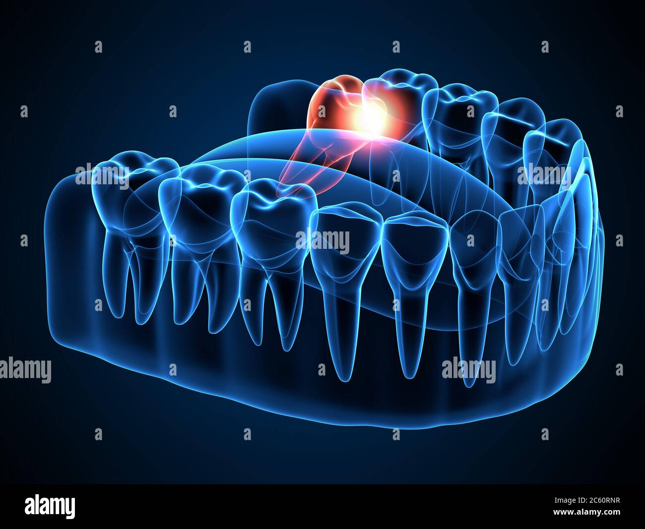 3d render of jaw x-ray with wisdom mesial impaction . Concept of different types of wisdom teeth problems. Stock Photo