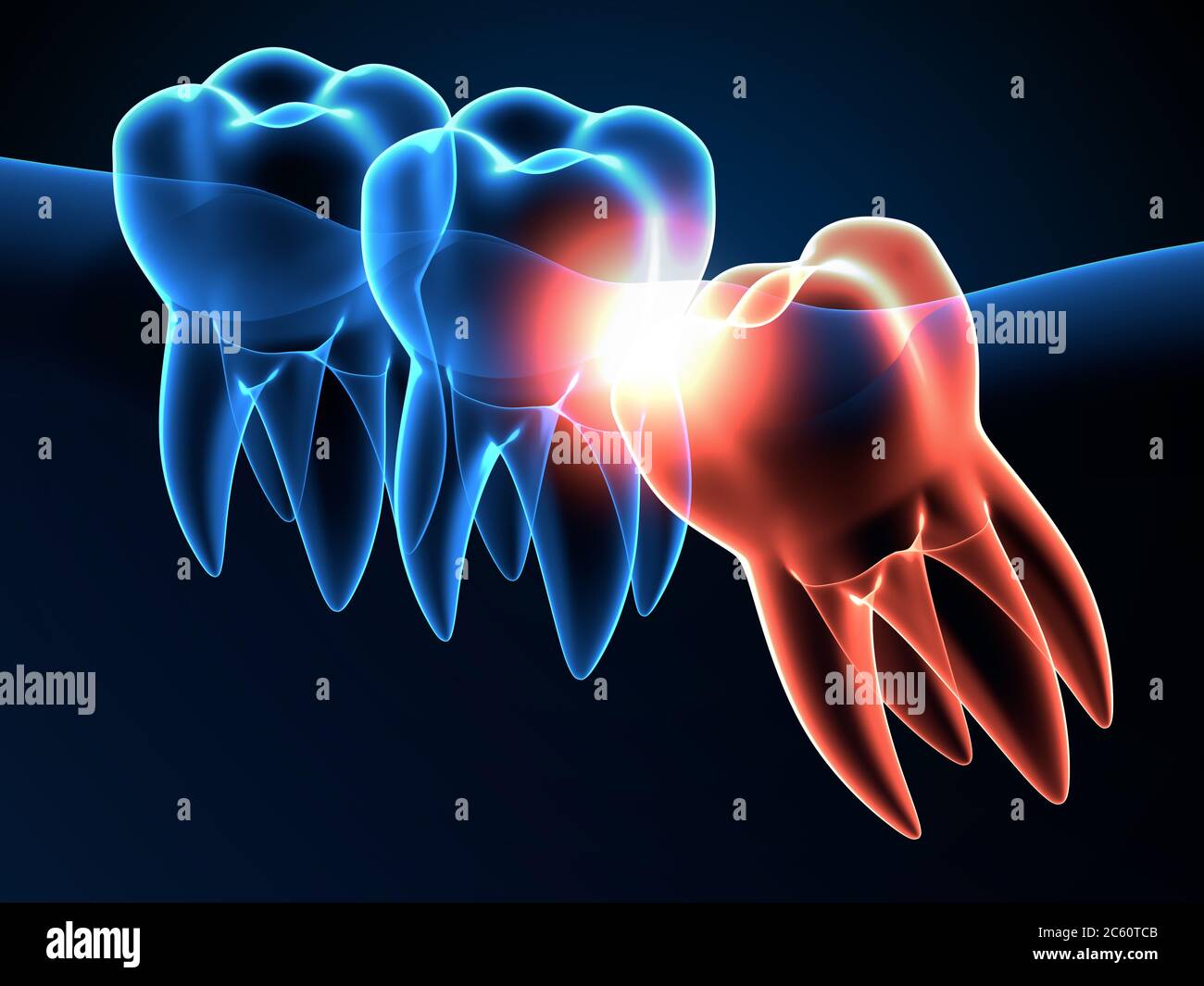 3d render of jaw x-ray with wisdom mesial impaction . Concept of ...