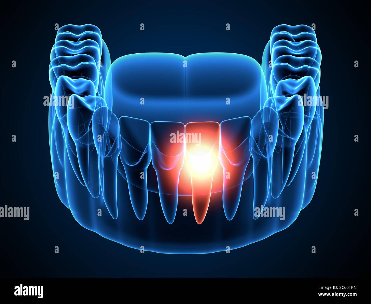 3d render of  jaw x-ray with aching molar tooth. Toothache concept. Stock Photo