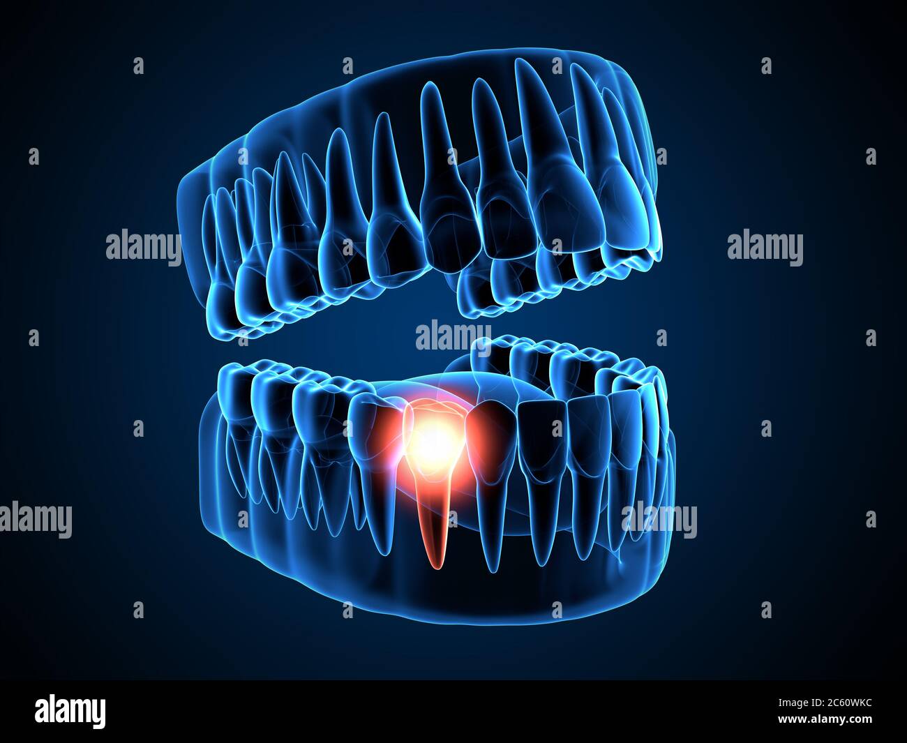 3d render of jaw xray with aching premolar tooth. Toothache concept