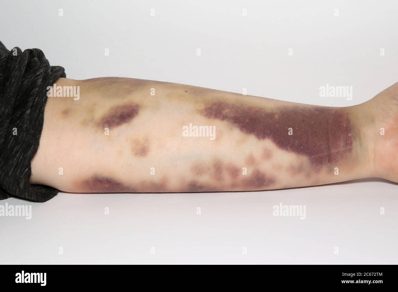 Blood Donation Bruises