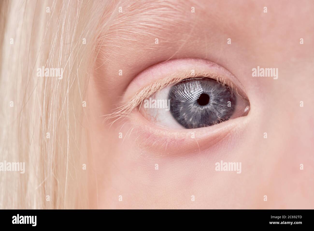 Albinism eyes hi-res stock photography and images - Alamy