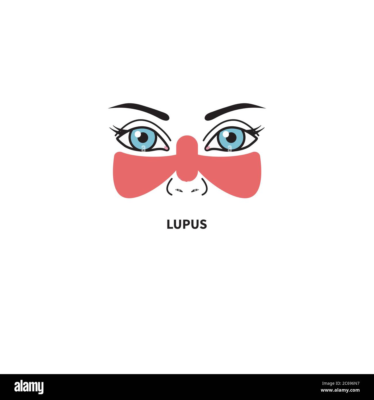Systemic lupus erythematosus. Woman with red spot on her face in shape of butterfly. Vector illustration Stock Vector