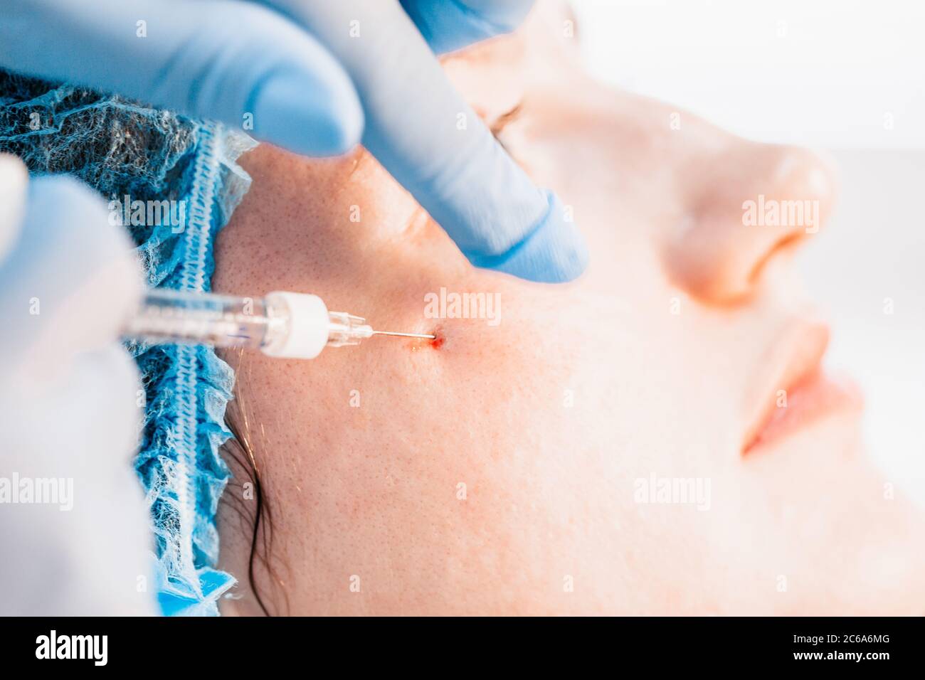 Contour plastics - injection rejuvenation by introducing into the ...