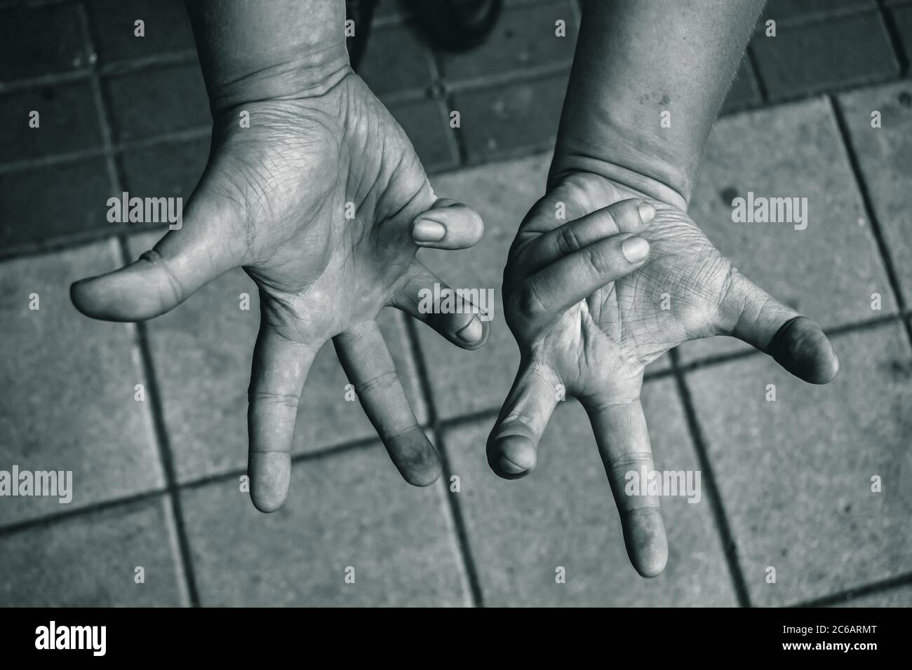 Numbness in the hands of a sick person, disorder of muscles