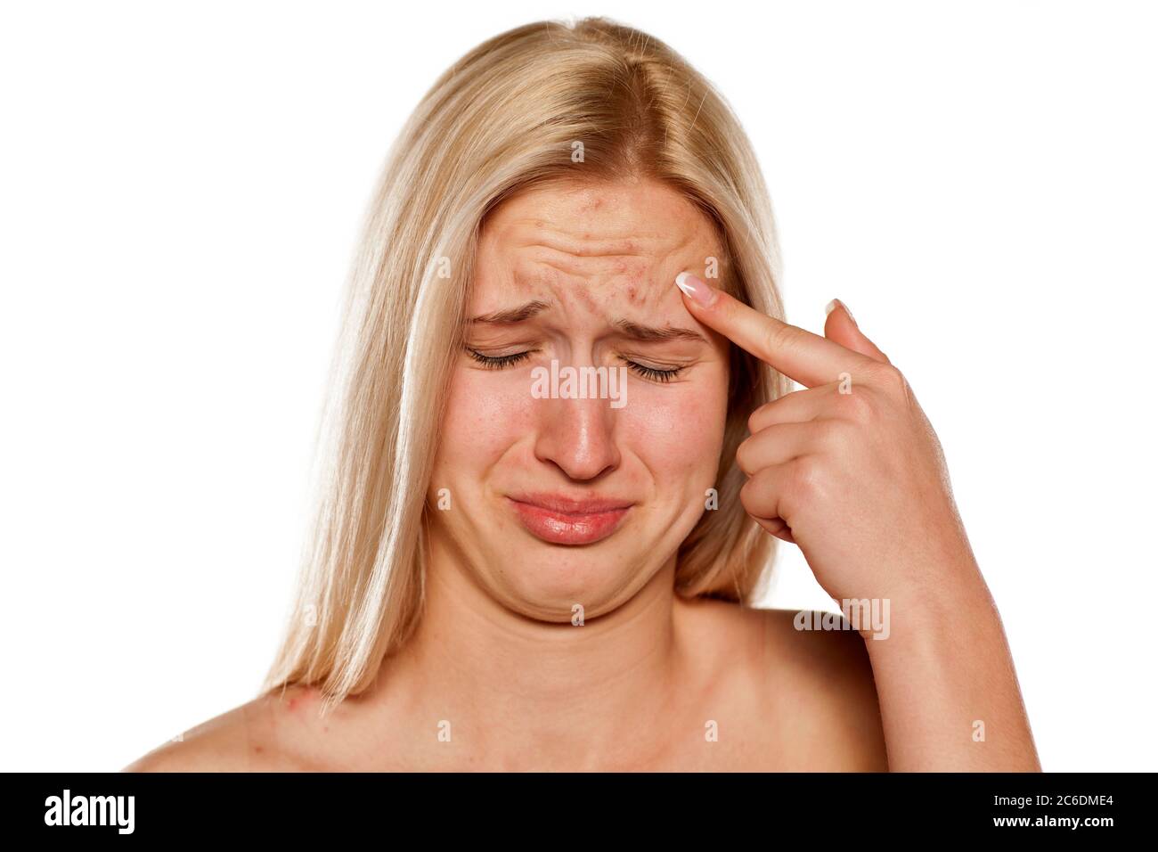 Sad blonde with pimples on her forehead Stock Photo
