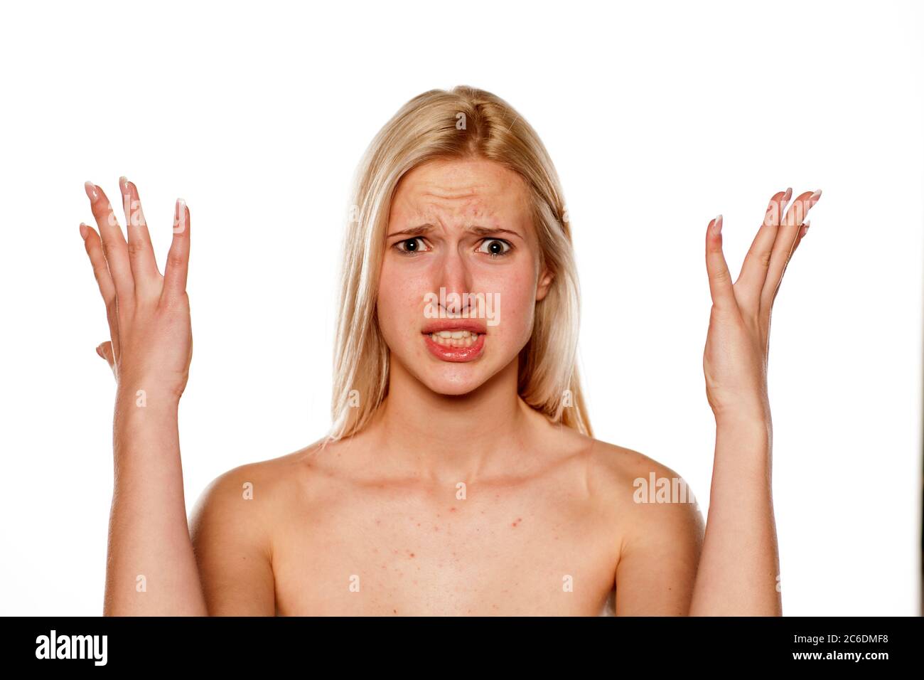 Upset blonde with pimples on her forehead Stock Photo