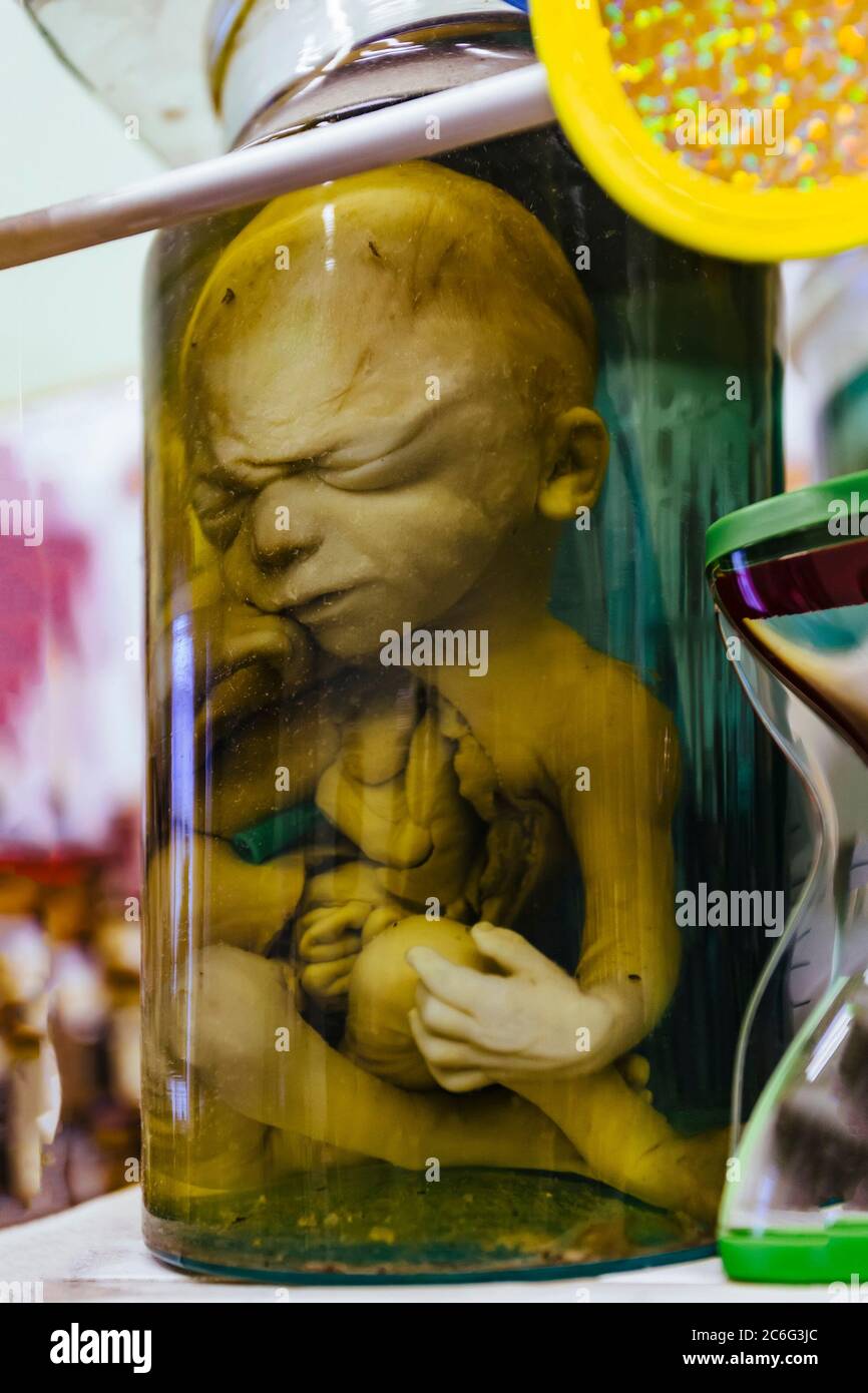 Human baby with with abnormal pathological development in glass jar with formalin Stock Photo