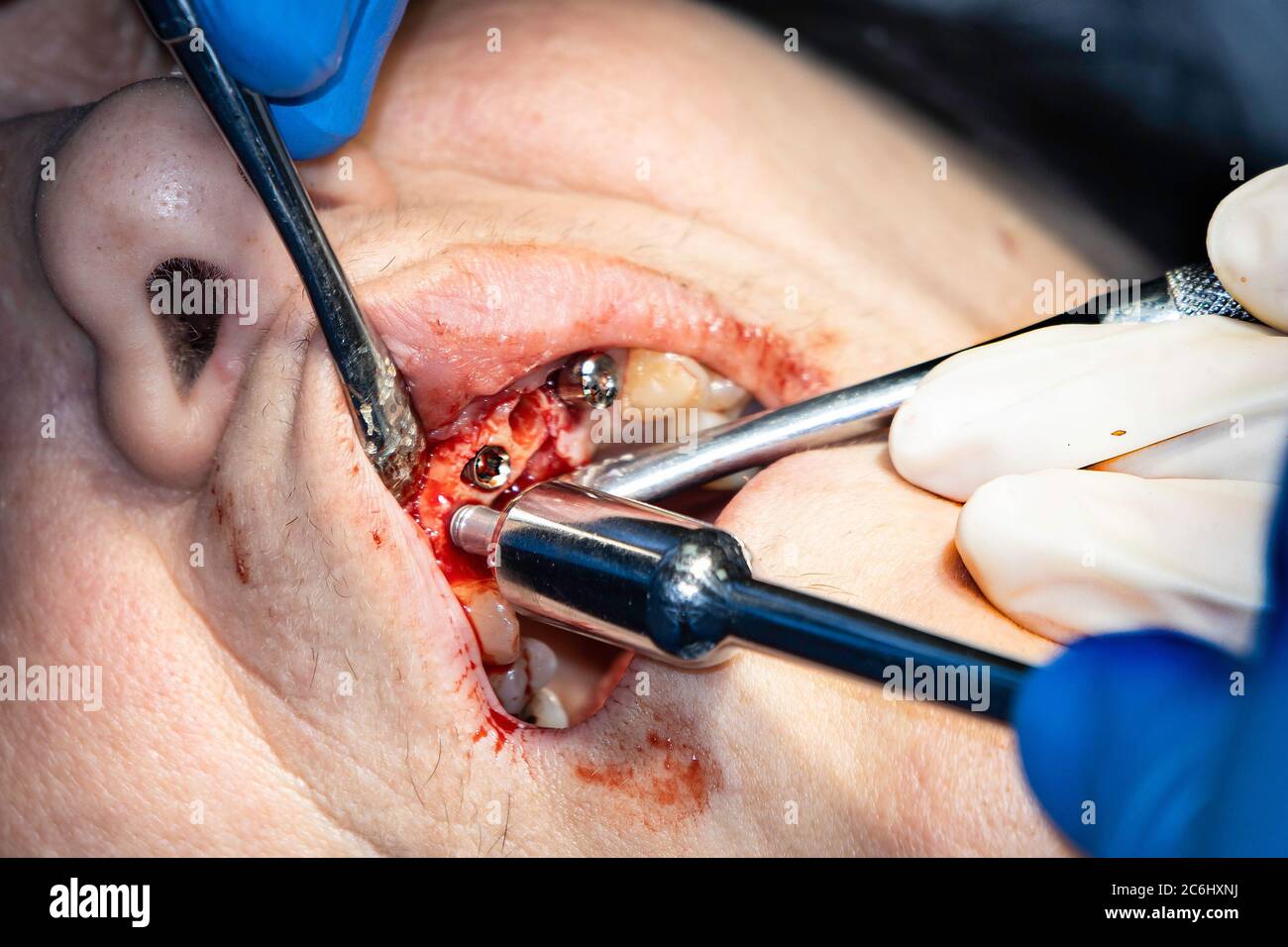 A closeup photograph of insertion of dental implants into a patient's upper jaw. Stock Photo